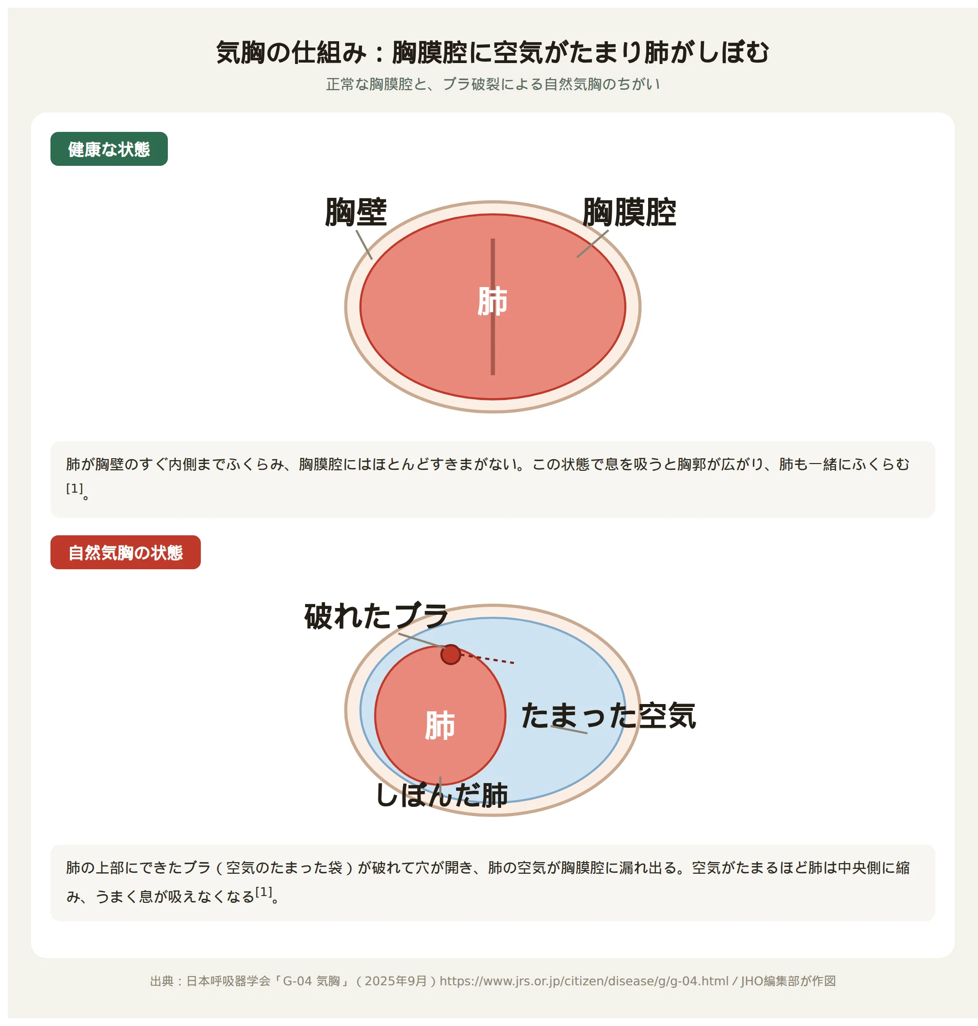 気胸の仕組み：正常な胸膜腔とブラ破裂による自然気胸の比較図