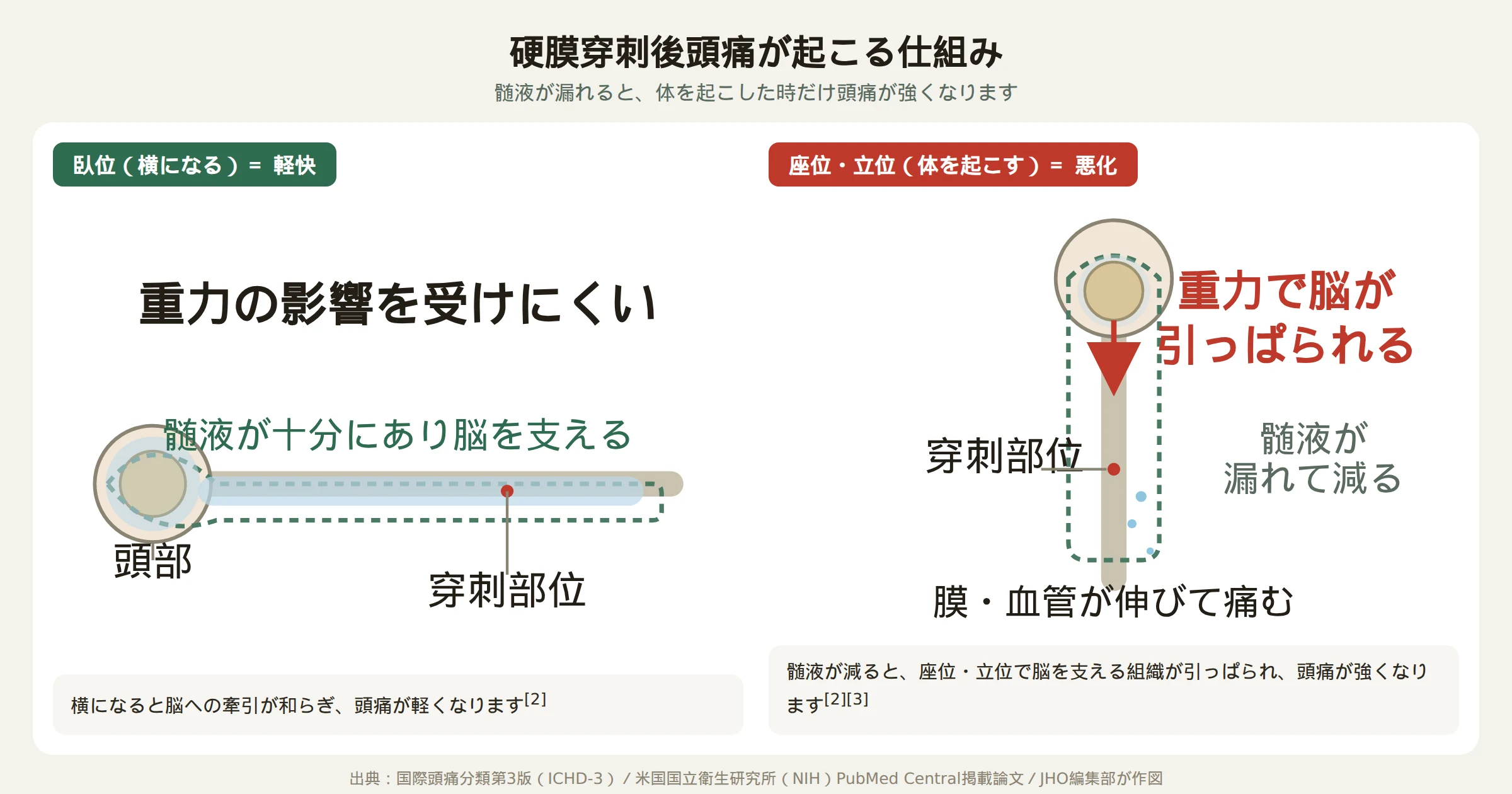 硬膜穿刺後に髄液が漏れて起立性頭痛が起こる仕組みを示す図
