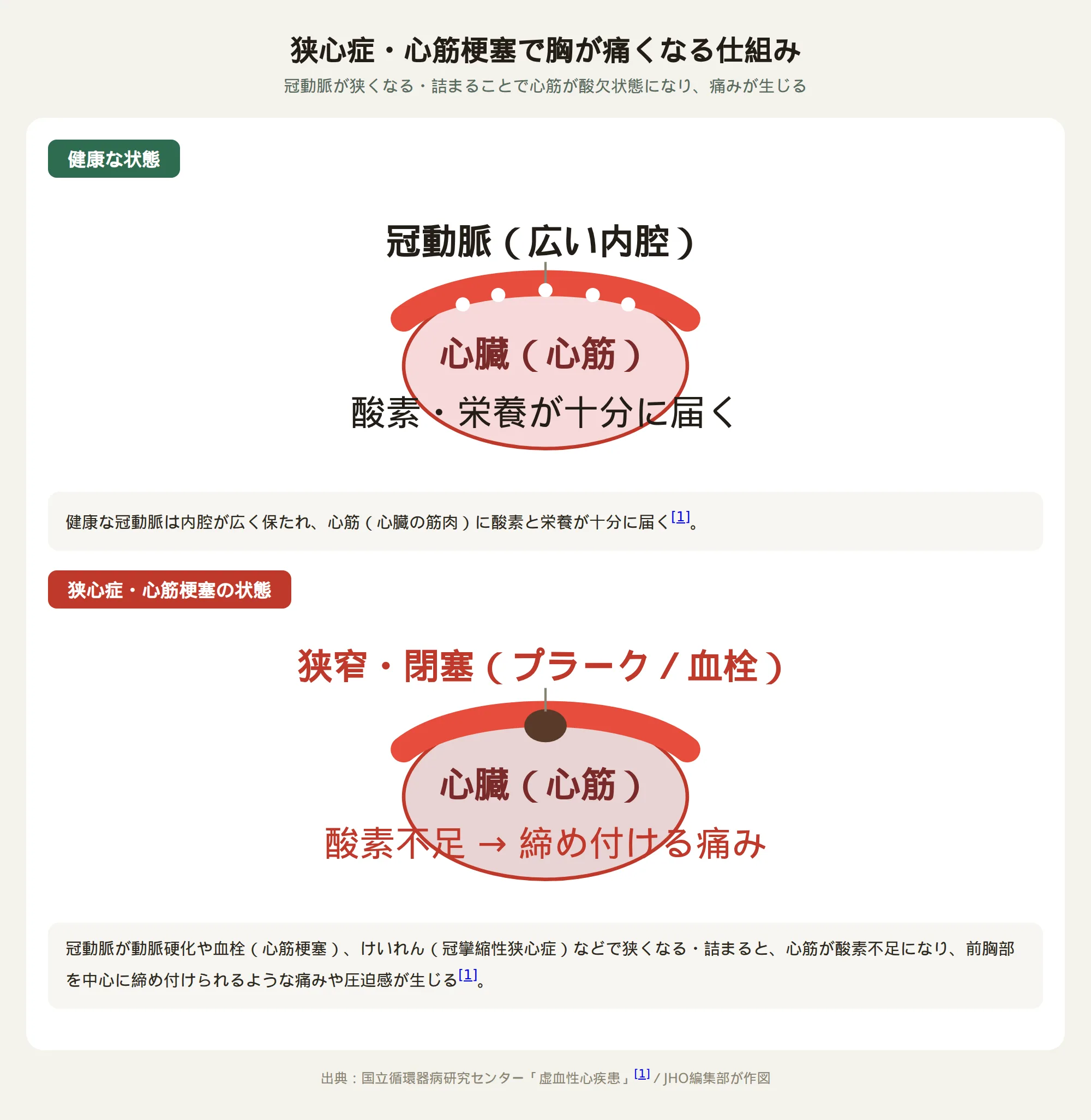 狭心症・心筋梗塞で胸が痛くなる仕組み：冠動脈が狭くなる・詰まることで心筋が酸欠になり痛みが生じる図