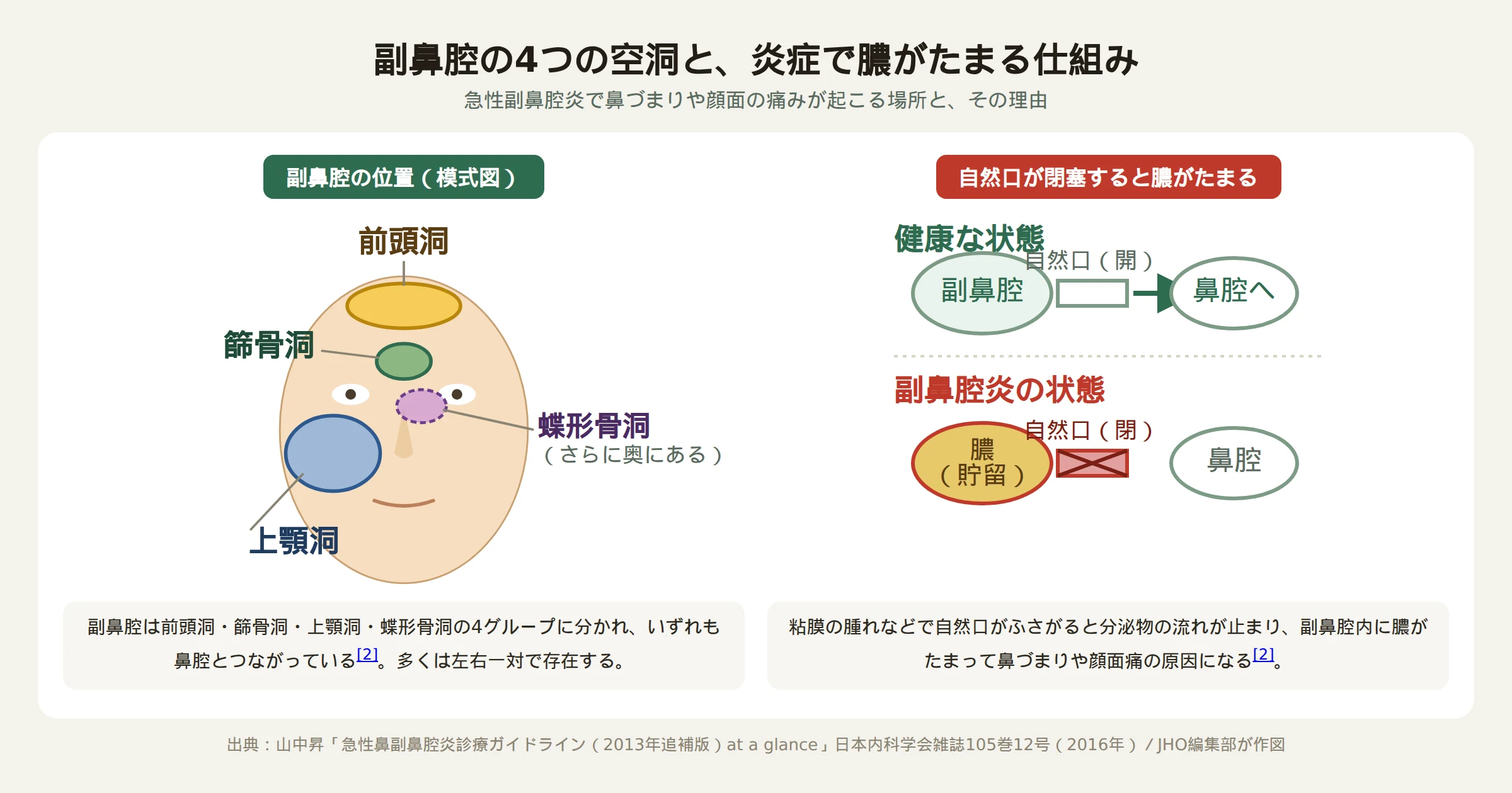 4つの副鼻腔の位置と自然口が閉塞して膿がたまる仕組みを示した解剖図