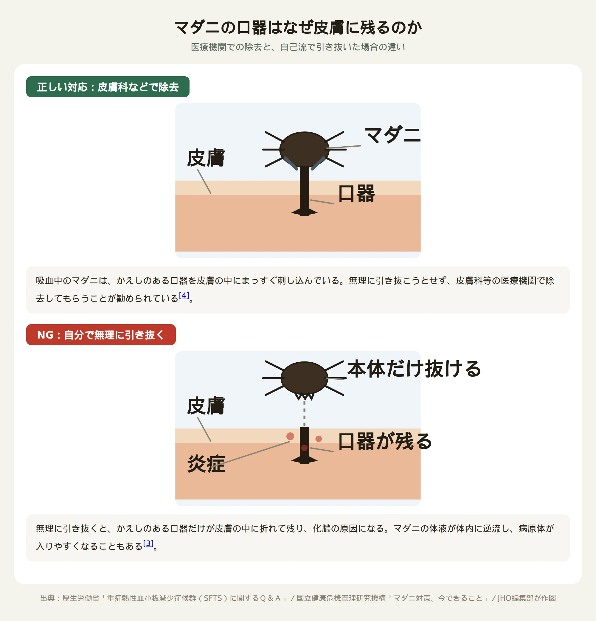 マダニの口器が皮膚に残る仕組みを示す図。正しい対応（医療機関での除去）と、自分で無理に引き抜いた場合に口器だけが皮膚に残って炎症を起こす様子を対比している