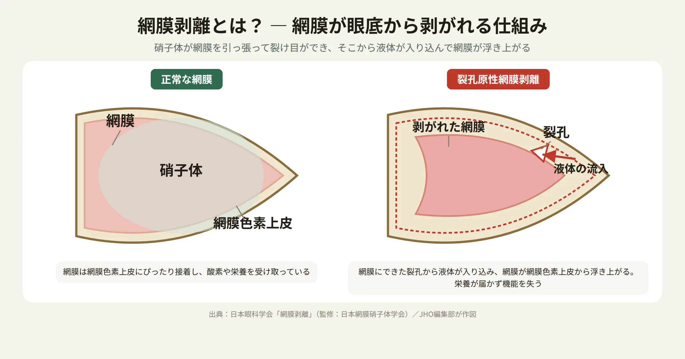 網膜剥離の仕組みを示す図。正常な網膜と、裂孔から液体が入り込み剥がれた網膜（裂孔原性網膜剥離）の断面比較