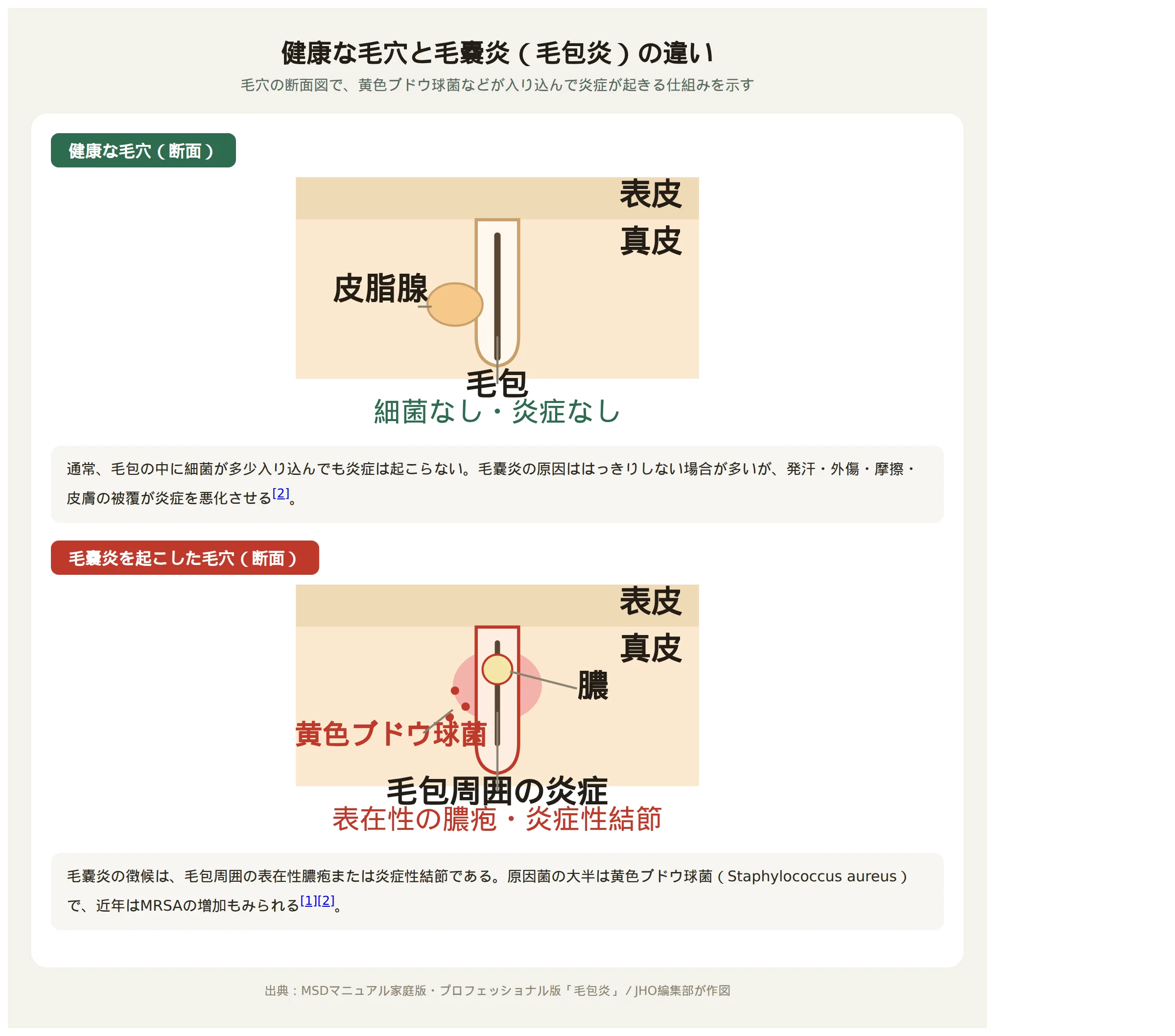 健康な毛穴と毛嚢炎を起こした毛穴の断面図の比較。毛包周囲に黄色ブドウ球菌が入り込み膿がたまる仕組みを示す