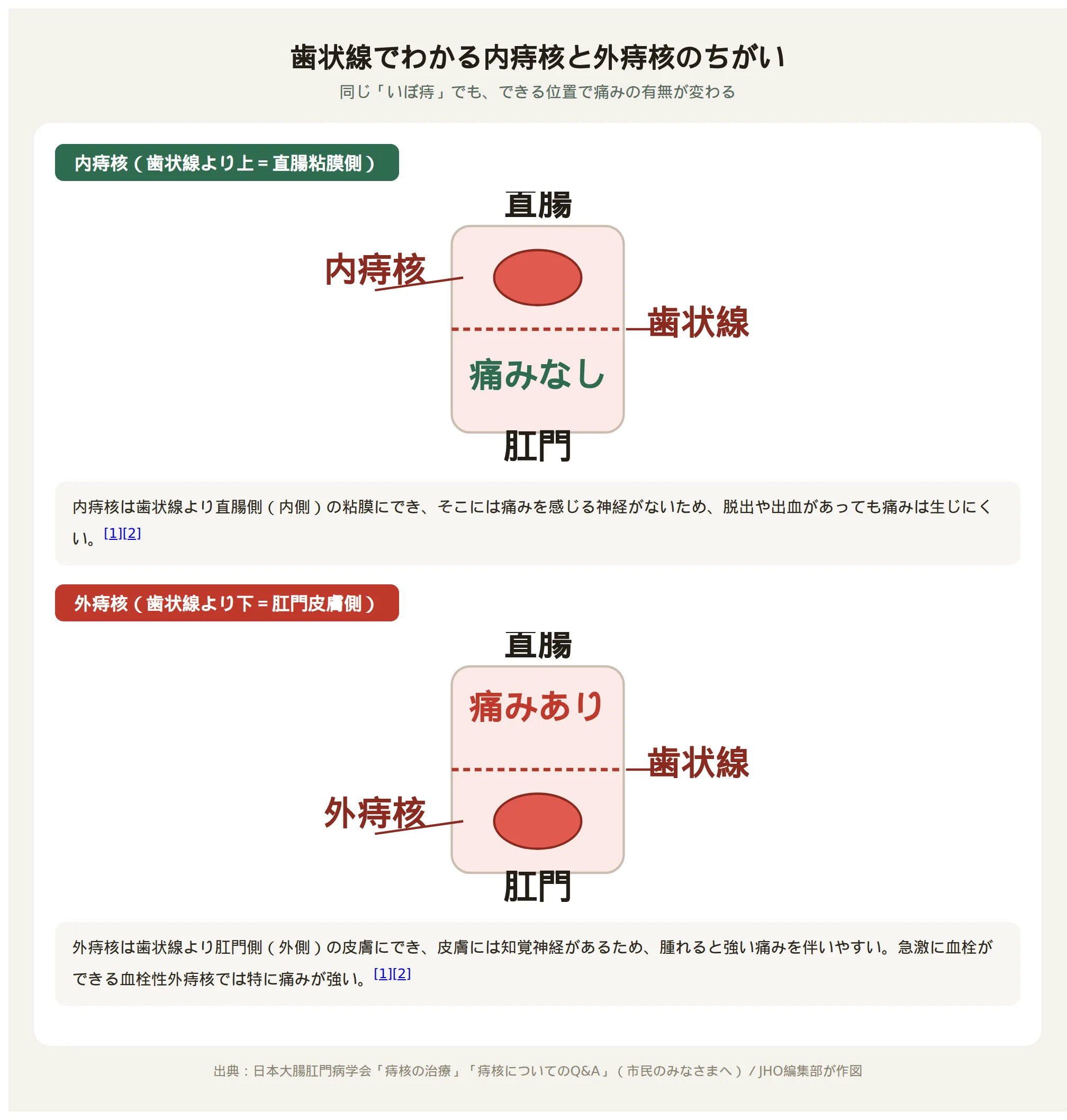 肛門管の断面図。歯状線を境に、直腸粘膜側にできる内痔核（痛みなし）と、肛門皮膚側にできる外痔核（痛みあり）の位置の違いを示す図