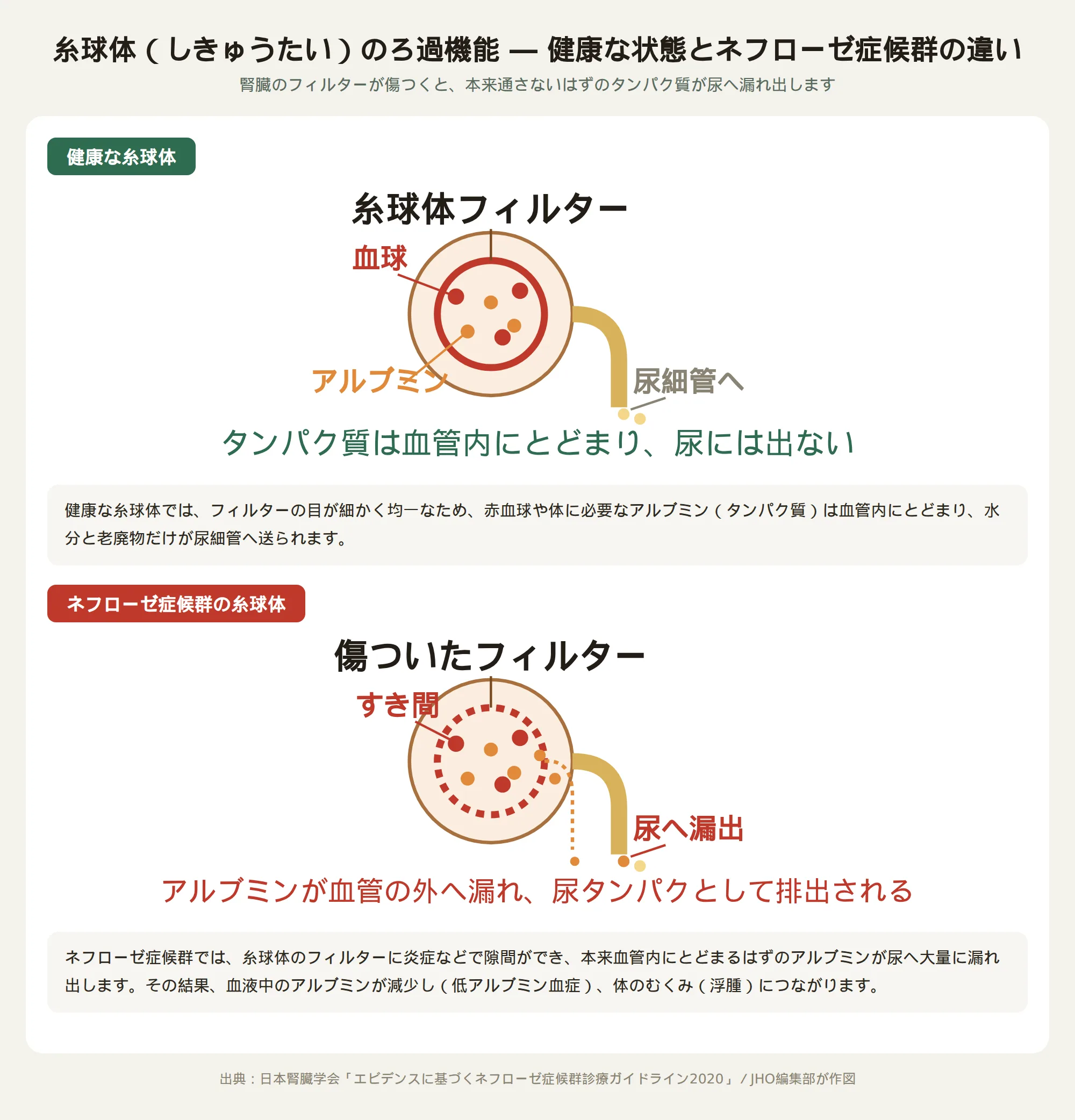 健康な糸球体とネフローゼ症候群の糸球体の違いを示す図。フィルターの隙間からアルブミンが漏れる様子
