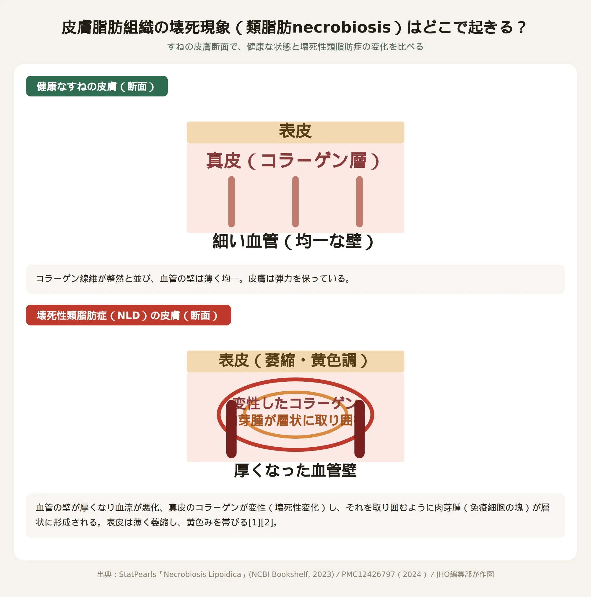 壊死性類脂肪症の仕組みを示す健康な皮膚と血管壁が厚くなった皮膚の断面模式図