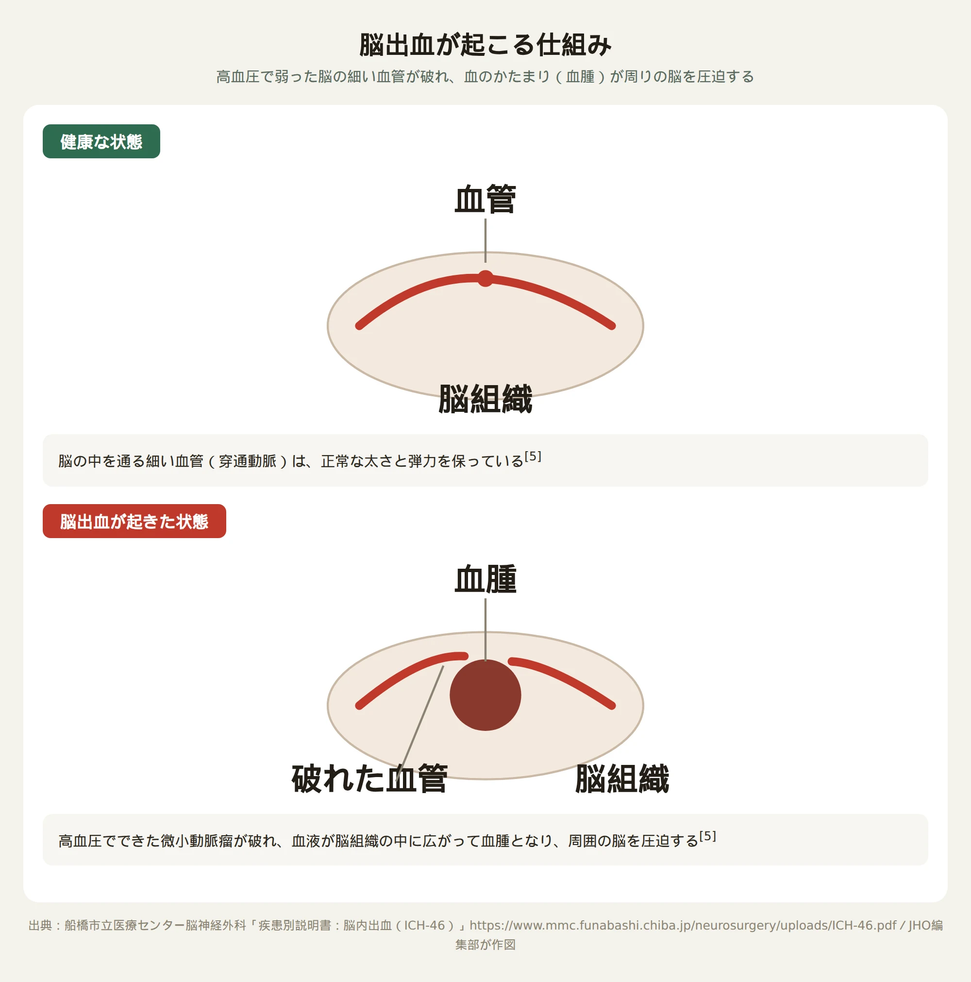 健康な脳の細い血管と、高血圧で血管が破れて血腫ができた状態を比較する図