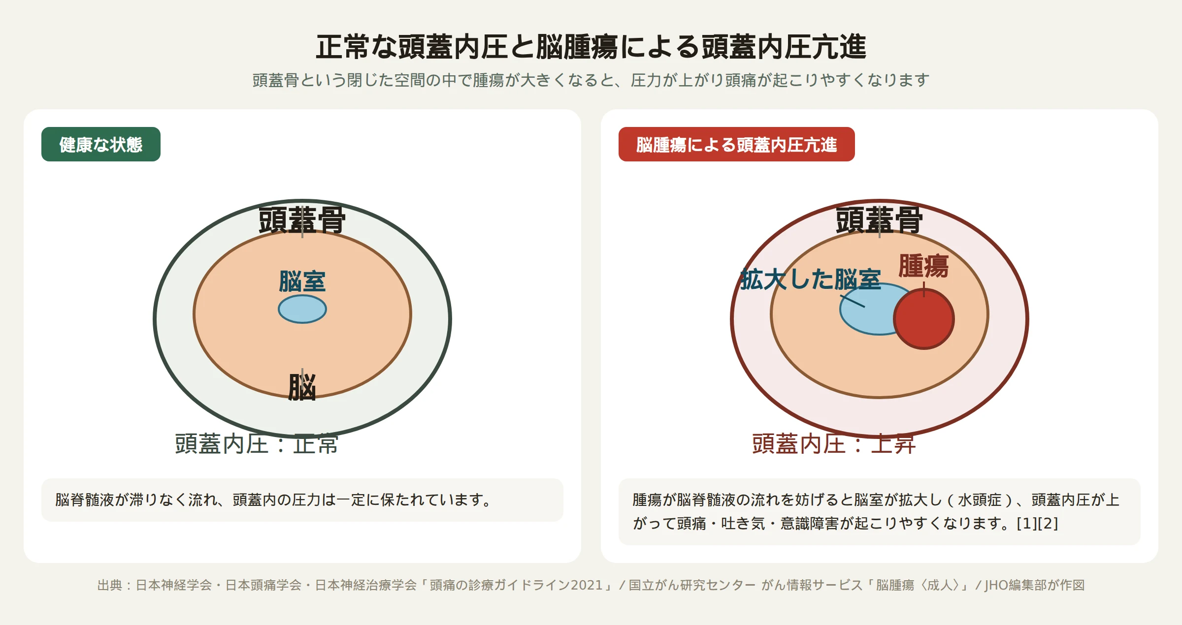 正常な頭蓋内圧と脳腫瘍で頭蓋内圧が高まった状態を並べて示した模式図