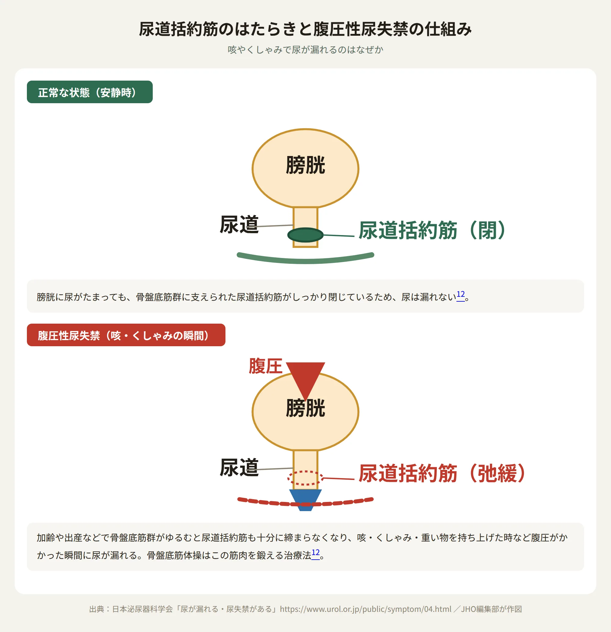 尿道括約筋と骨盤底筋群のはたらき：正常時は尿道括約筋が閉じて尿を保持するが、腹圧性尿失禁では筋肉がゆるみ咳やくしゃみの瞬間に尿が漏れる仕組みを示す図