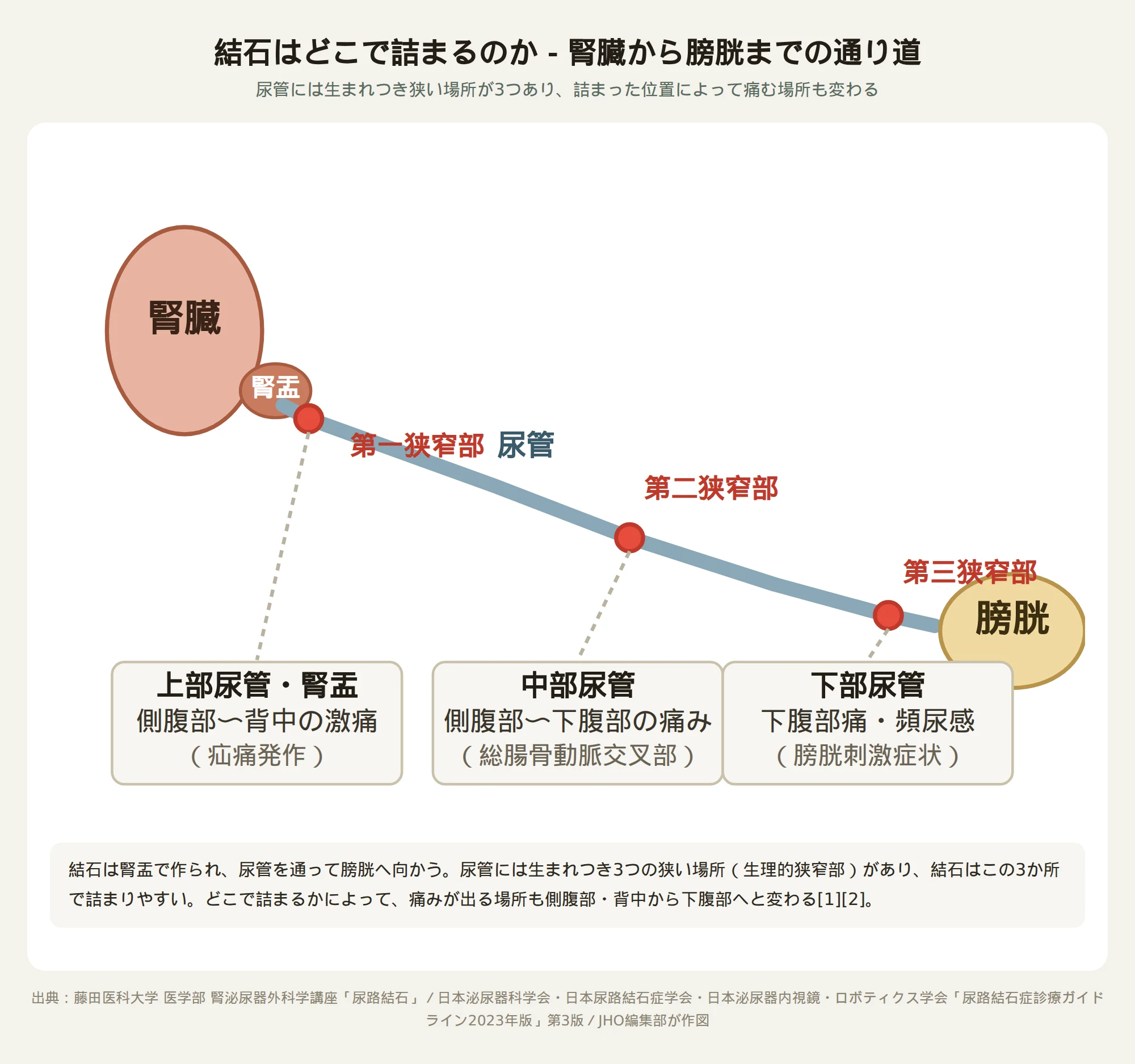 腎臓から膀胱までの結石の通り道と、尿管の生理的狭窄部で詰まりやすい位置および痛む部位を示した図