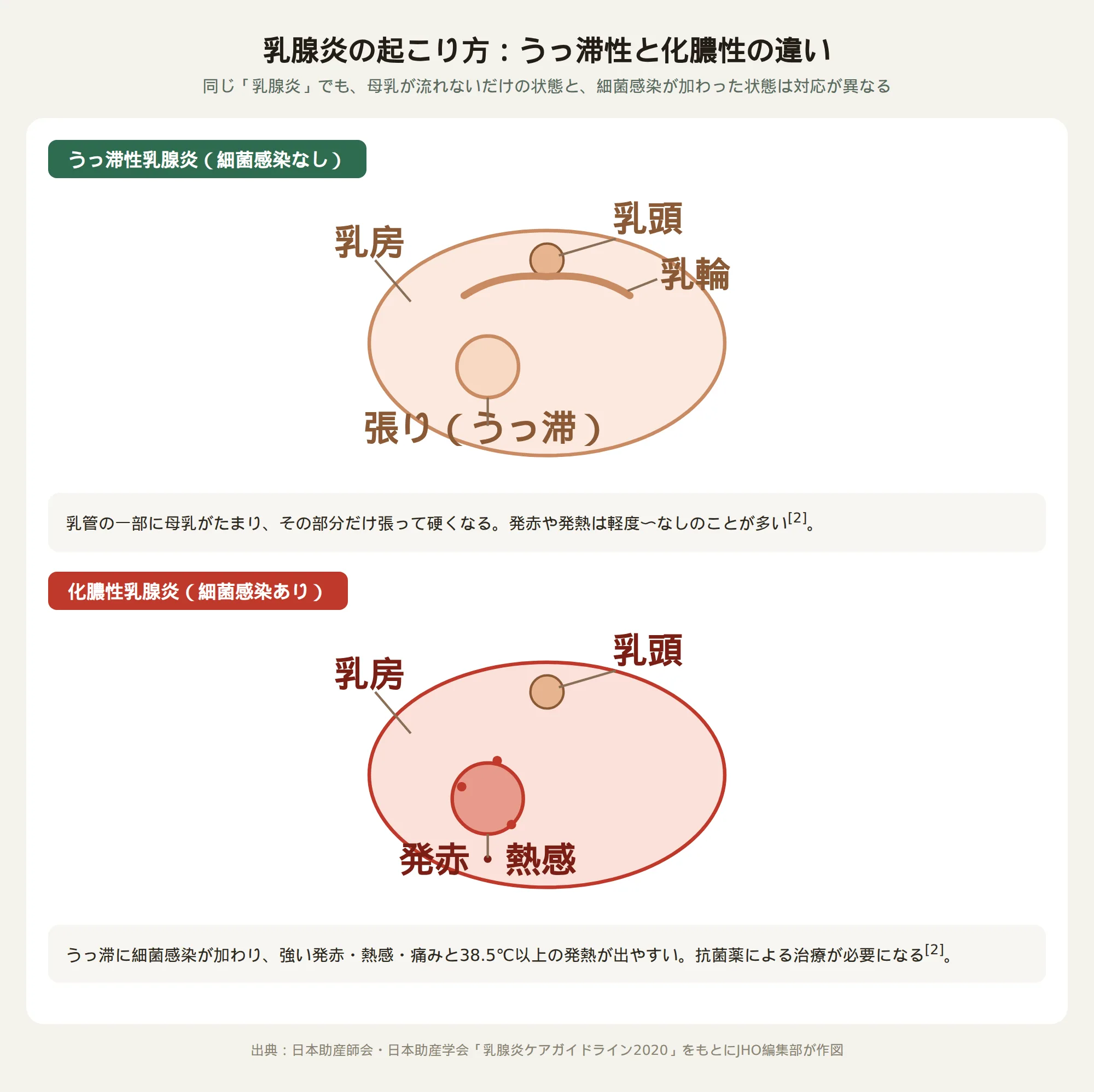 うっ滞性乳腺炎と化膿性乳腺炎の違いを示す乳房の断面図。乳房・乳頭・乳輪の位置と、うっ滞による張り、細菌感染による発赤・熱感を比較したイラスト