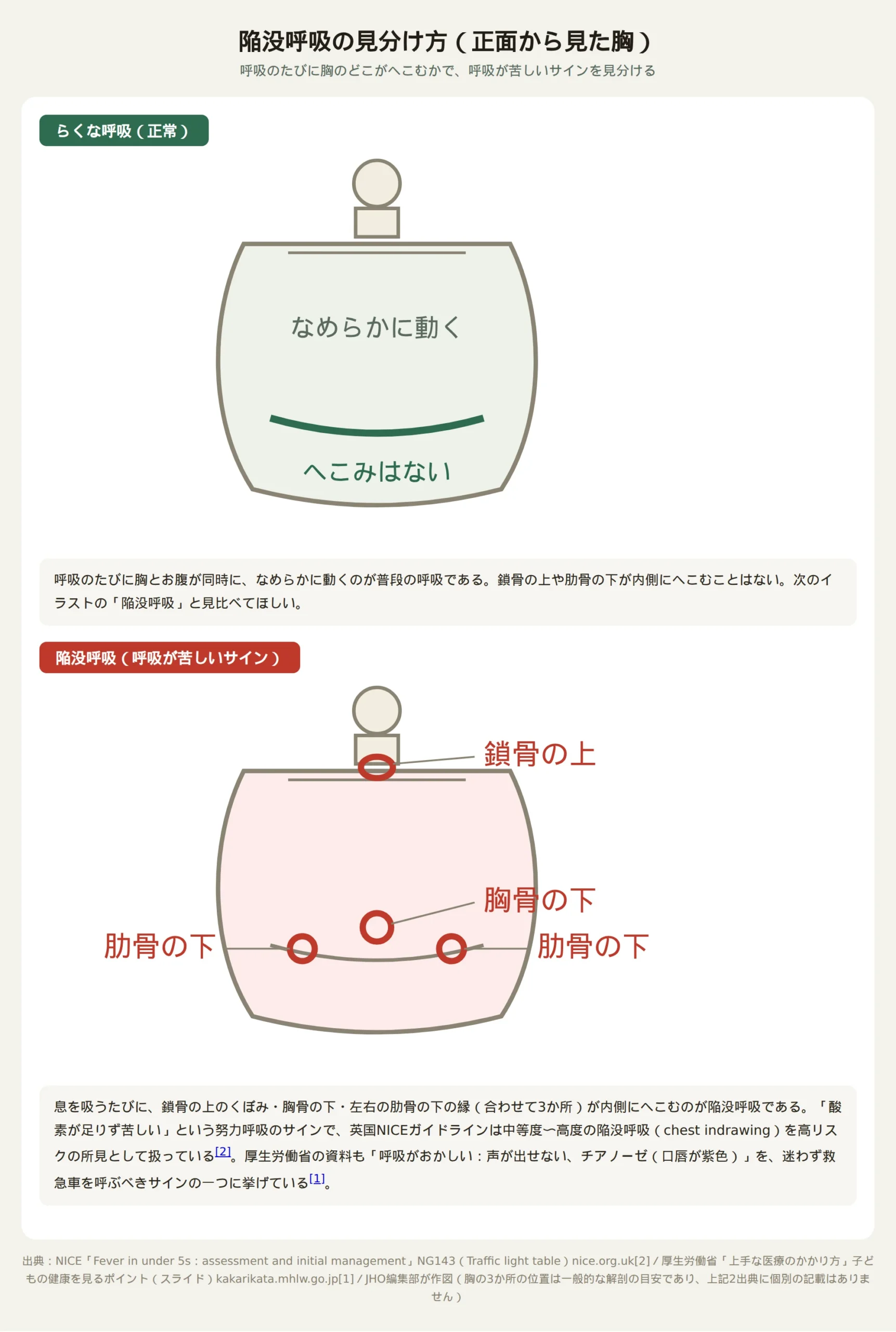陥没呼吸の見分け方を正常な呼吸と比較したイラスト。正常な呼吸では胸とお腹が同時になめらかに動きへこみはない。陥没呼吸では息を吸うたびに鎖骨の上のくぼみ、胸骨の下、肋骨の下の縁が内側にへこむ様子を、3か所の赤い丸印と説明線で示す