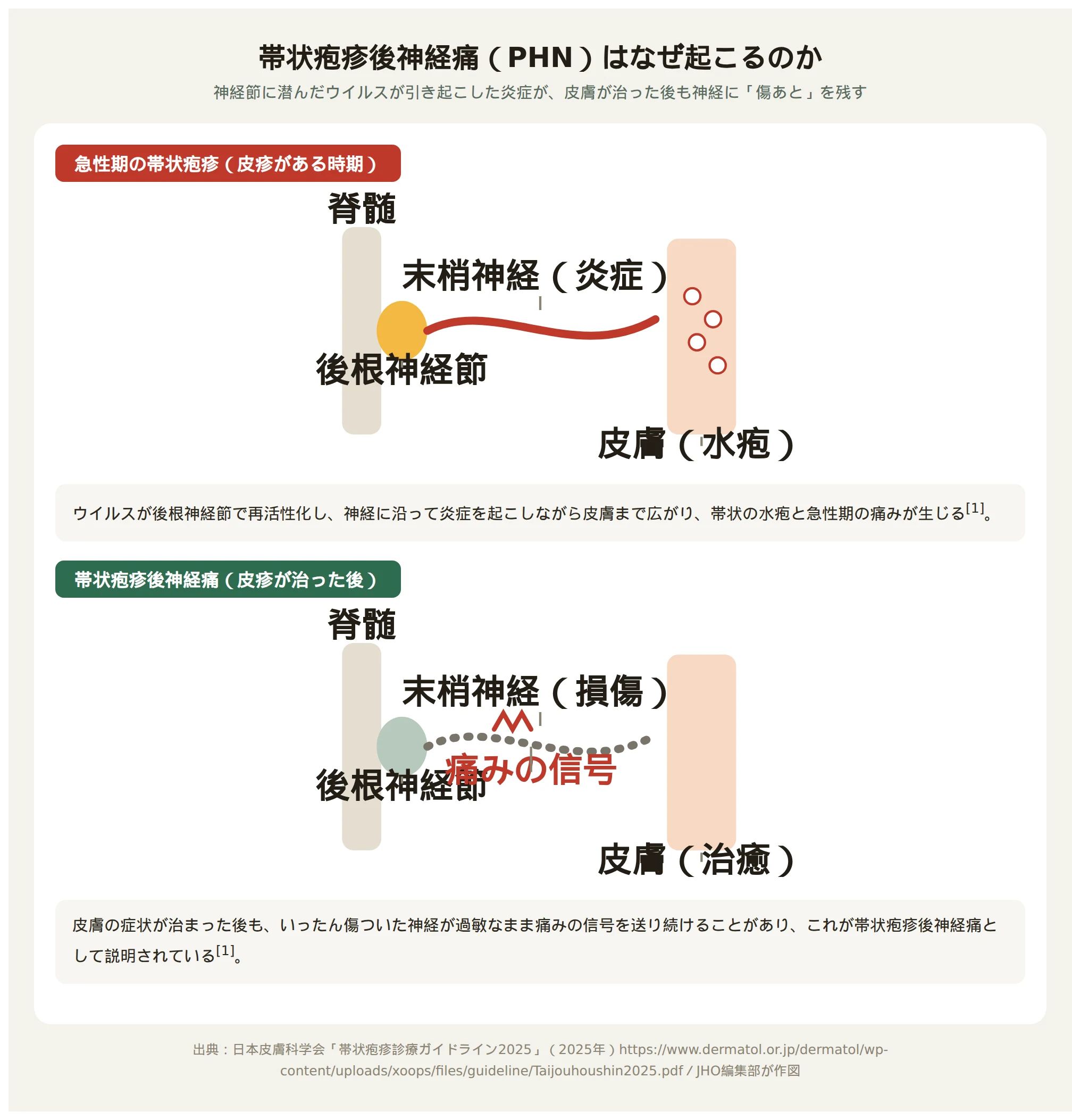 脊髄の後根神経節でウイルスが再活性化し神経に沿って皮膚に水疱が生じる急性期帯状疱疹と、皮疹が治った後も神経が損傷を受けたまま痛みの信号を送り続ける帯状疱疹後神経痛を上下2段で比較した断面図