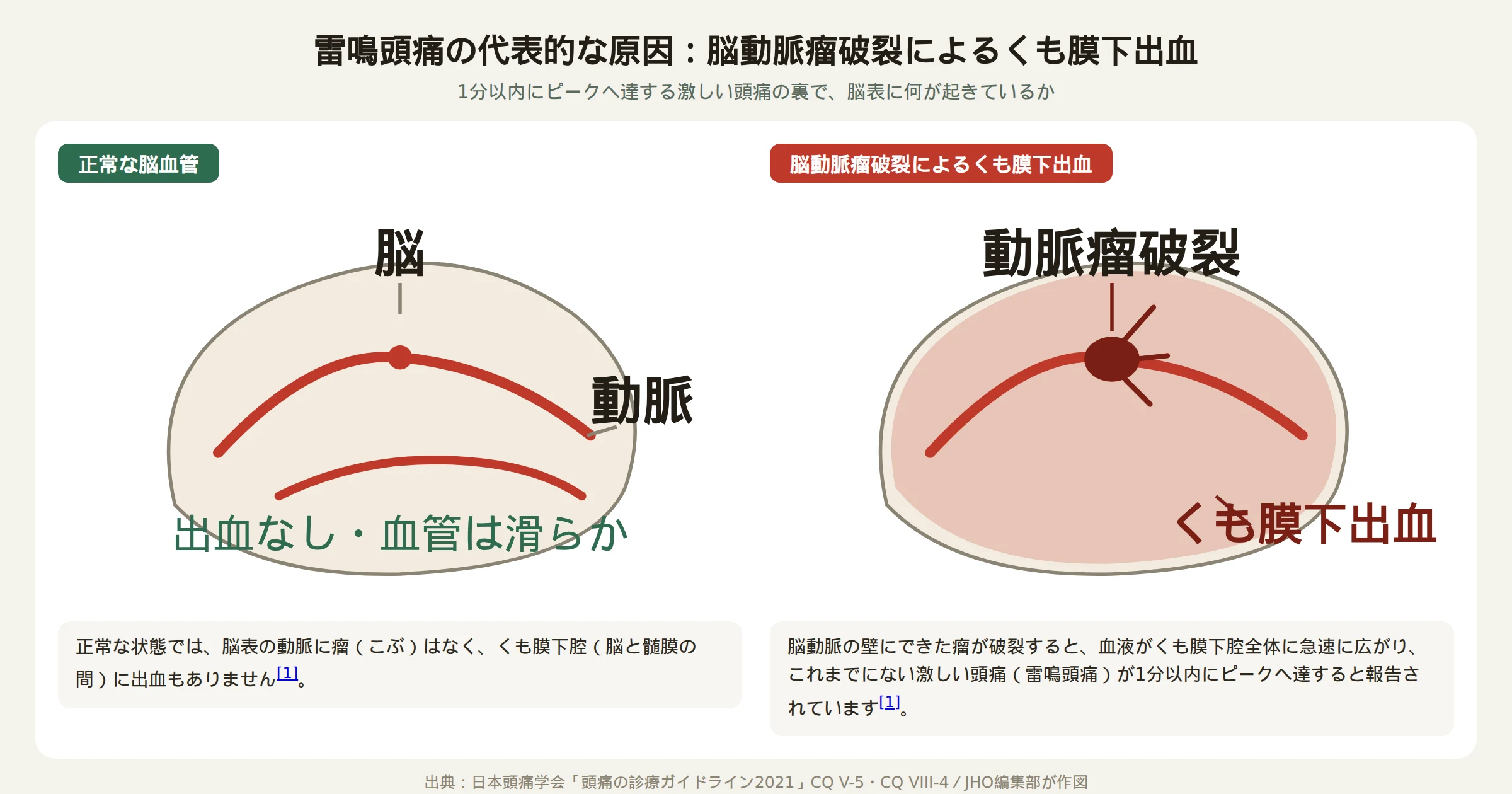 雷鳴頭痛の代表的な原因である脳動脈瘤破裂によるくも膜下出血の仕組みを示す図解。正常な脳血管と、動脈瘤が破裂して脳表にくも膜下出血が広がった状態を対比している