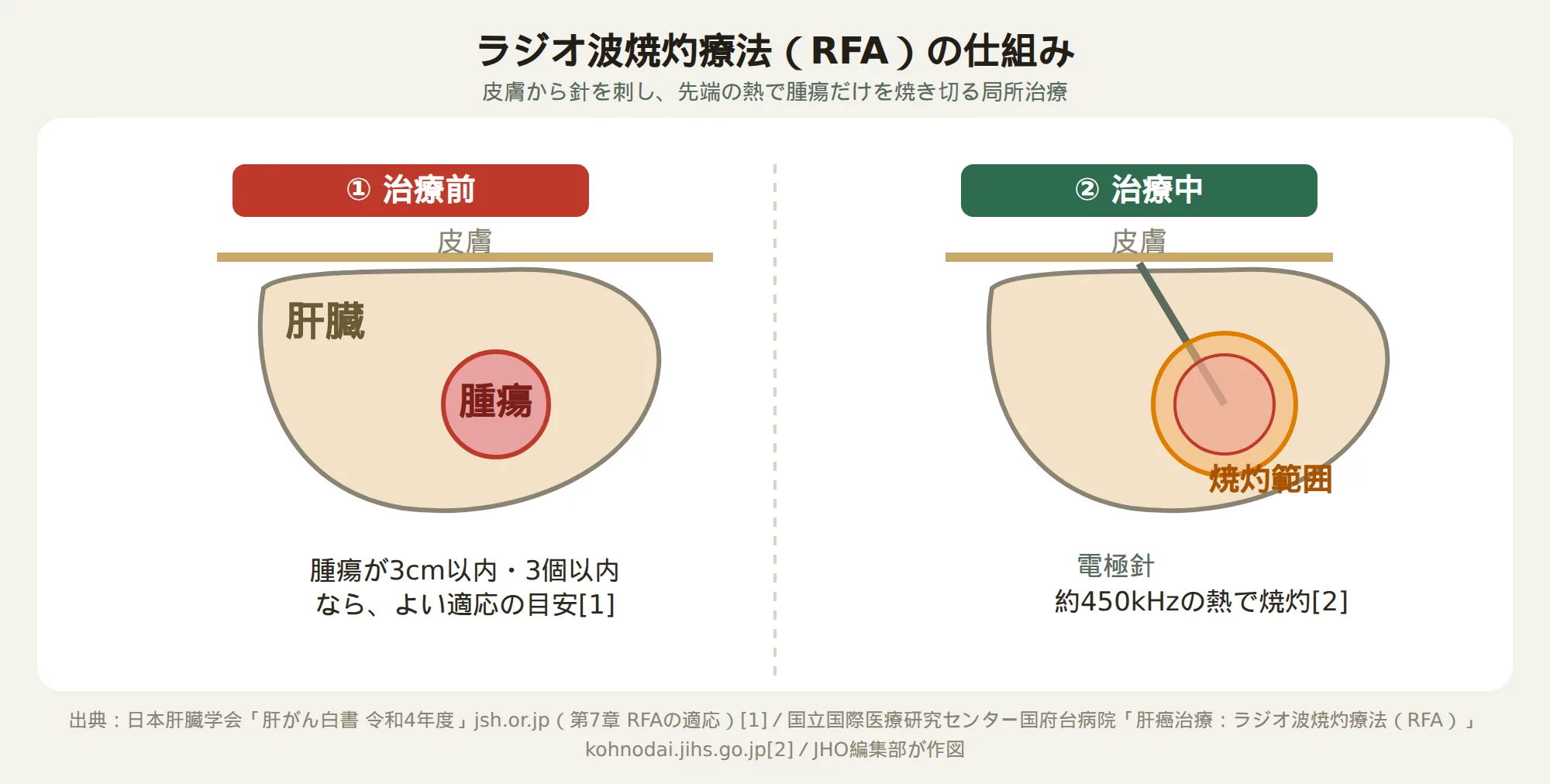 肝臓がんのラジオ波焼灼療法（RFA）の仕組み