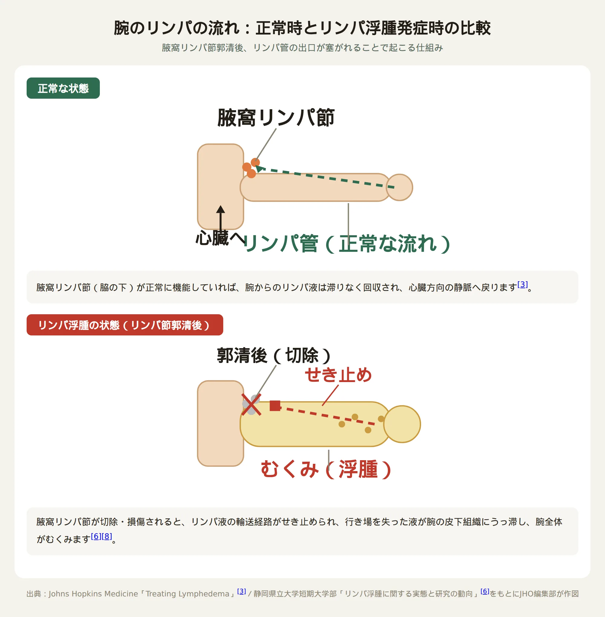 腕のリンパの流れ：正常時とリンパ浮腫（腋窩リンパ節郭清後）を起こす仕組み