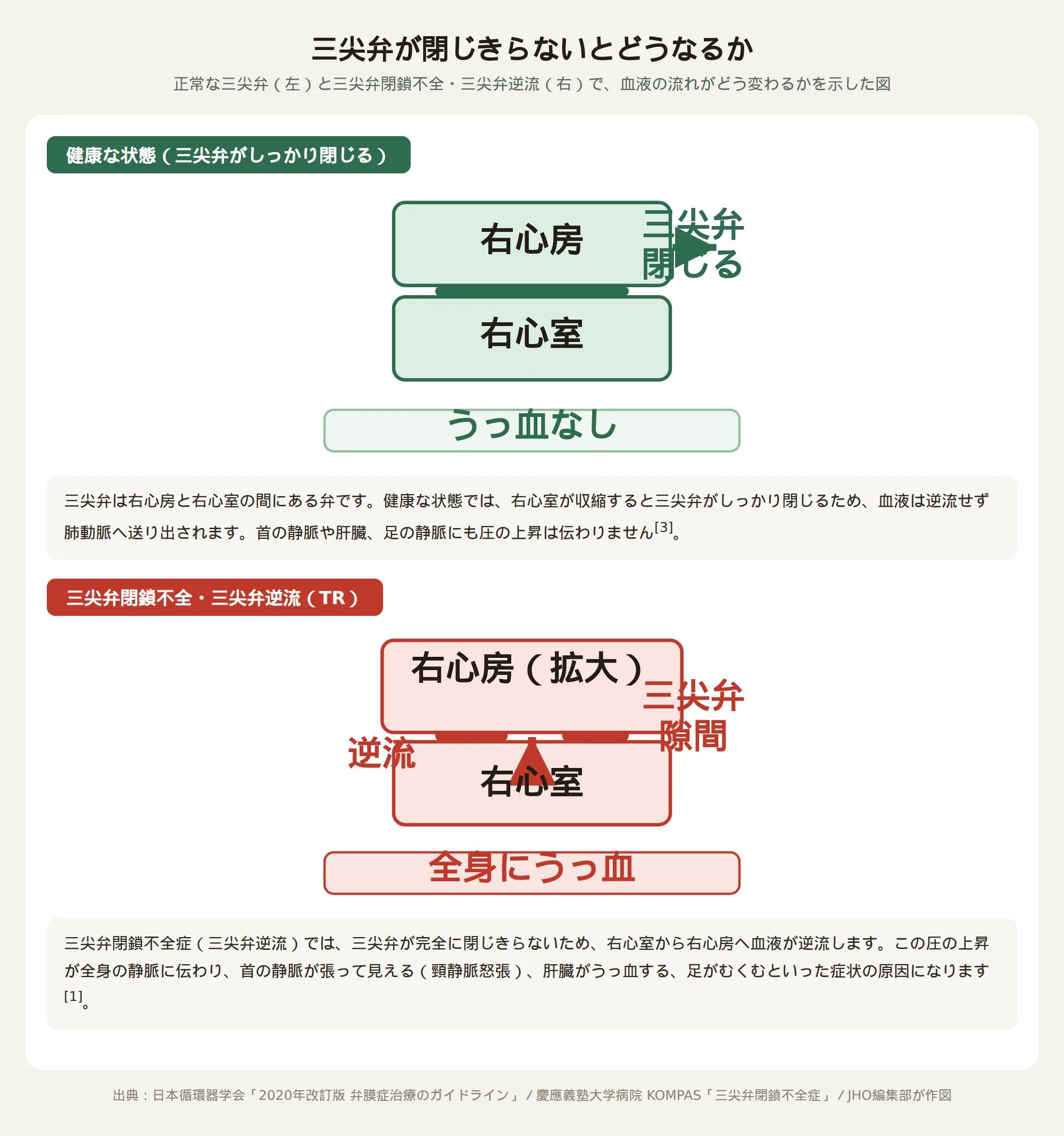 三尖弁が閉じきらず右心房へ血液が逆流し、全身の静脈にうっ血が起こる仕組みを示した図
