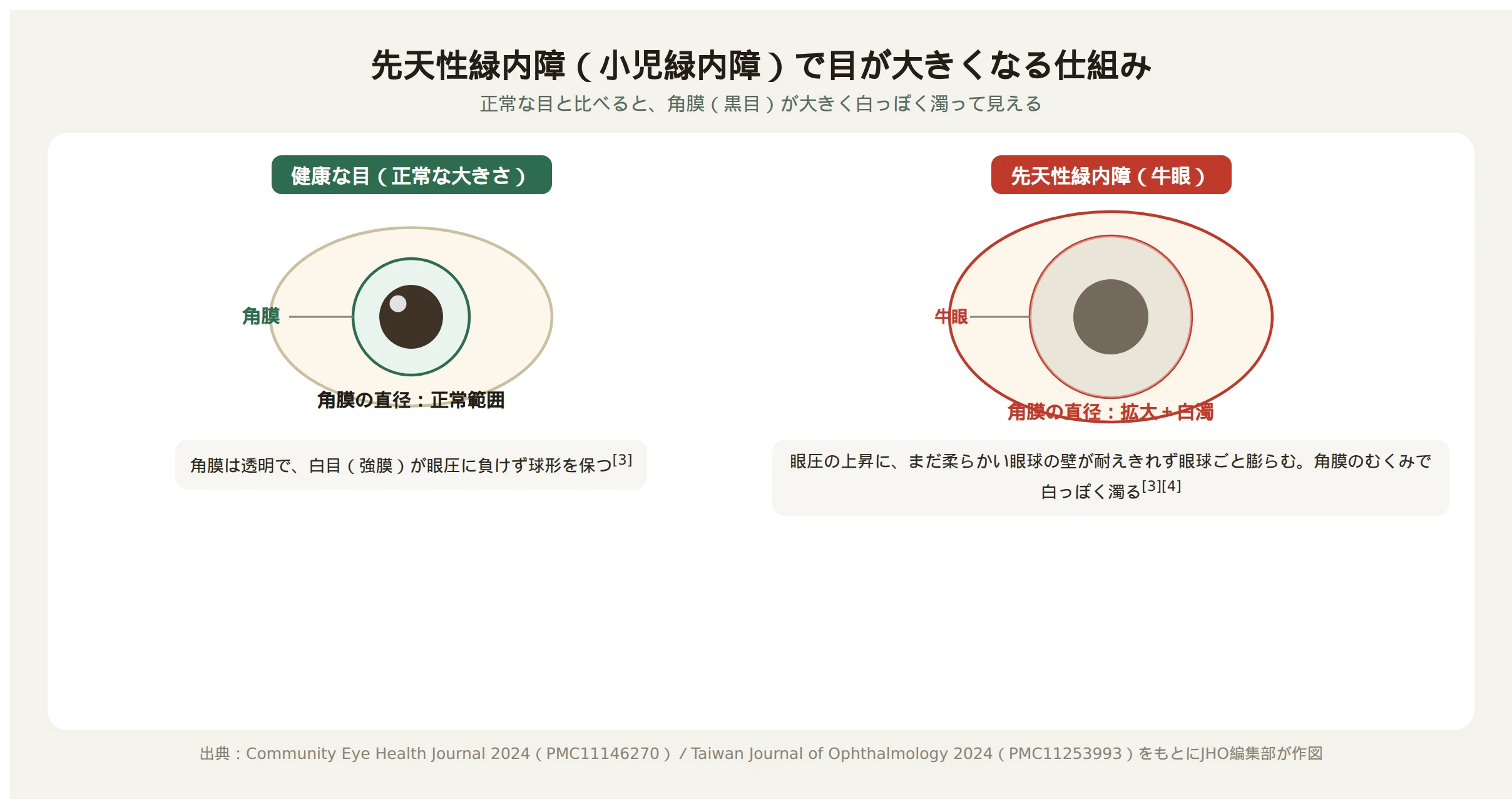 先天性緑内障で目が大きくなる仕組みを示す図