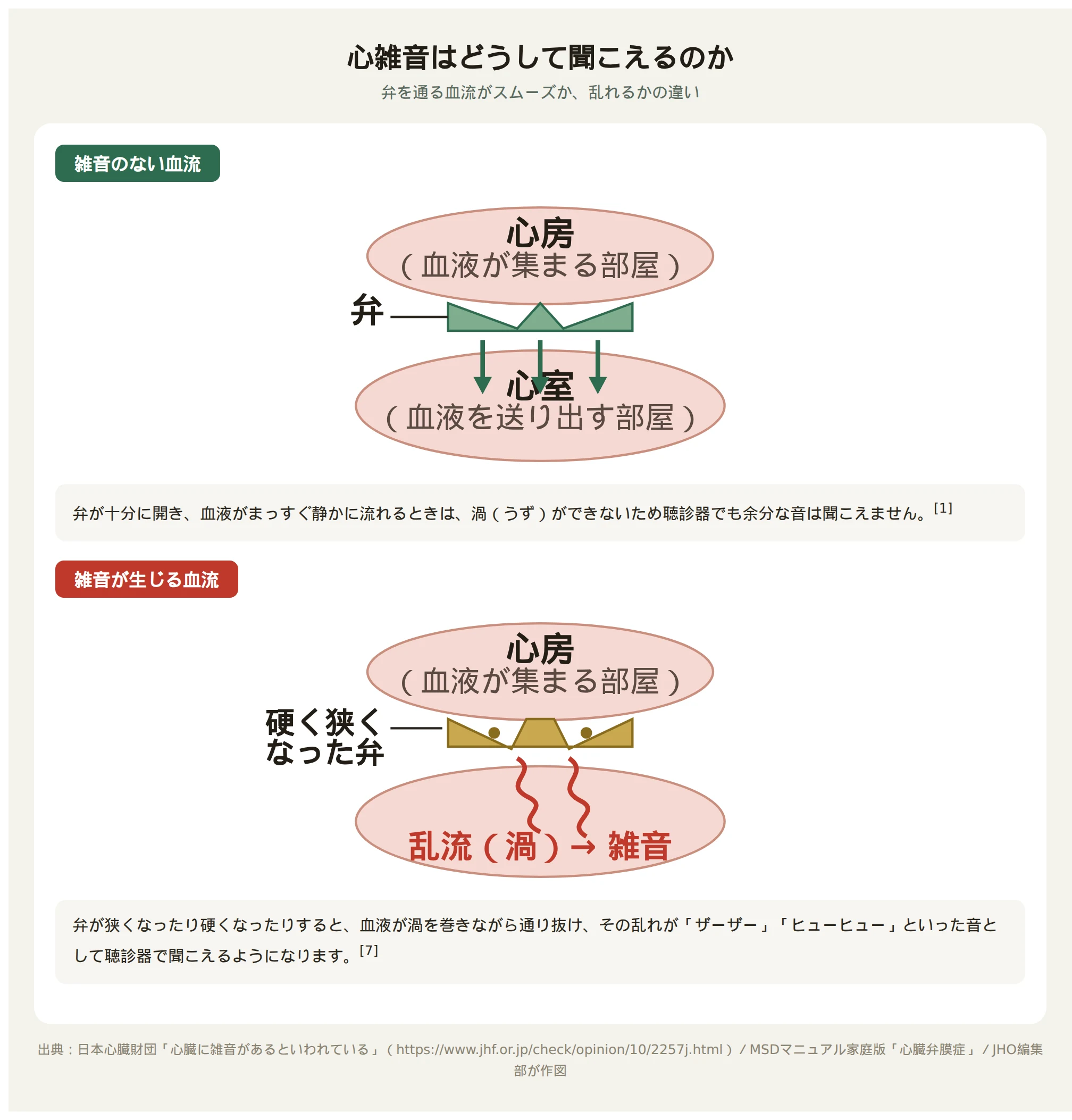 心雑音が生じる仕組み。正常な弁をスムーズに血液が流れる様子と、狭く硬くなった弁を血液が乱れながら通り抜ける様子を対比した図