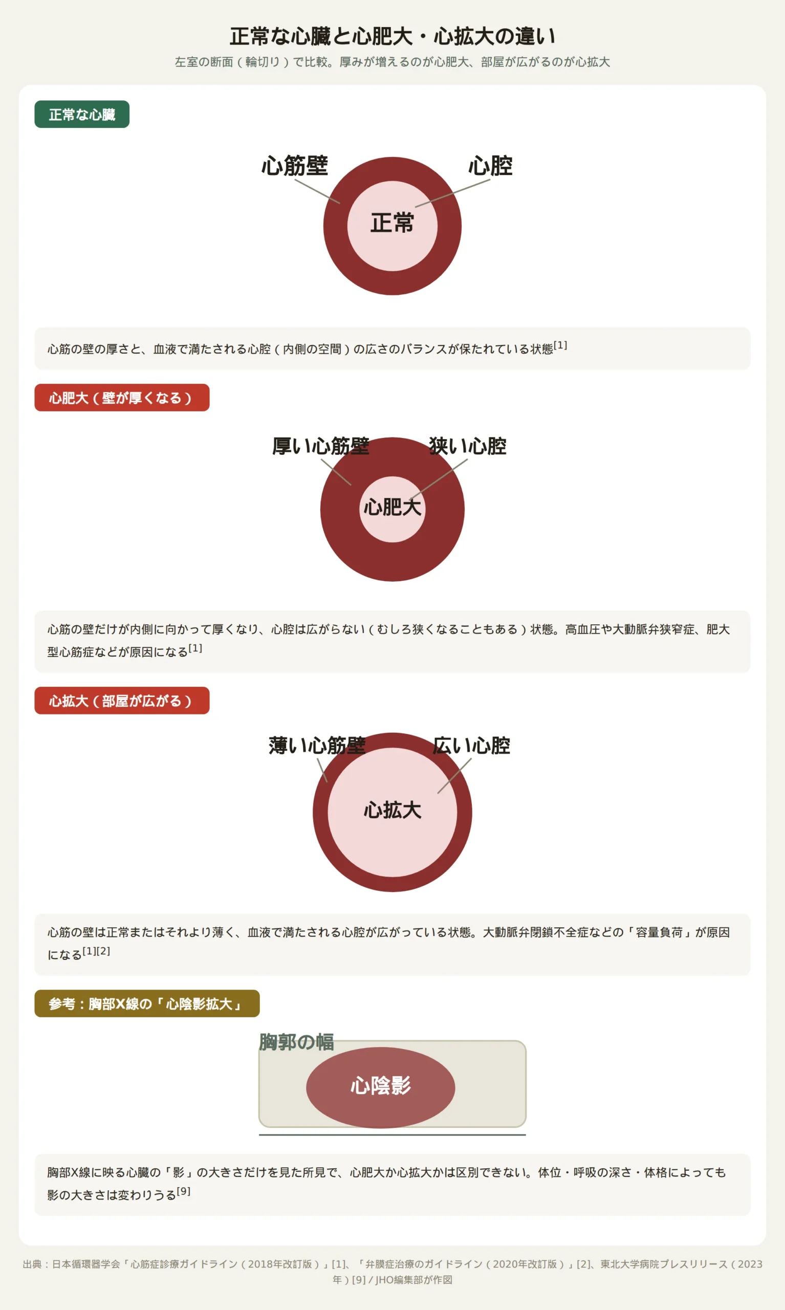 正常な心臓と心肥大・心拡大の違い、および胸部X線での心陰影拡大との区別を示した図