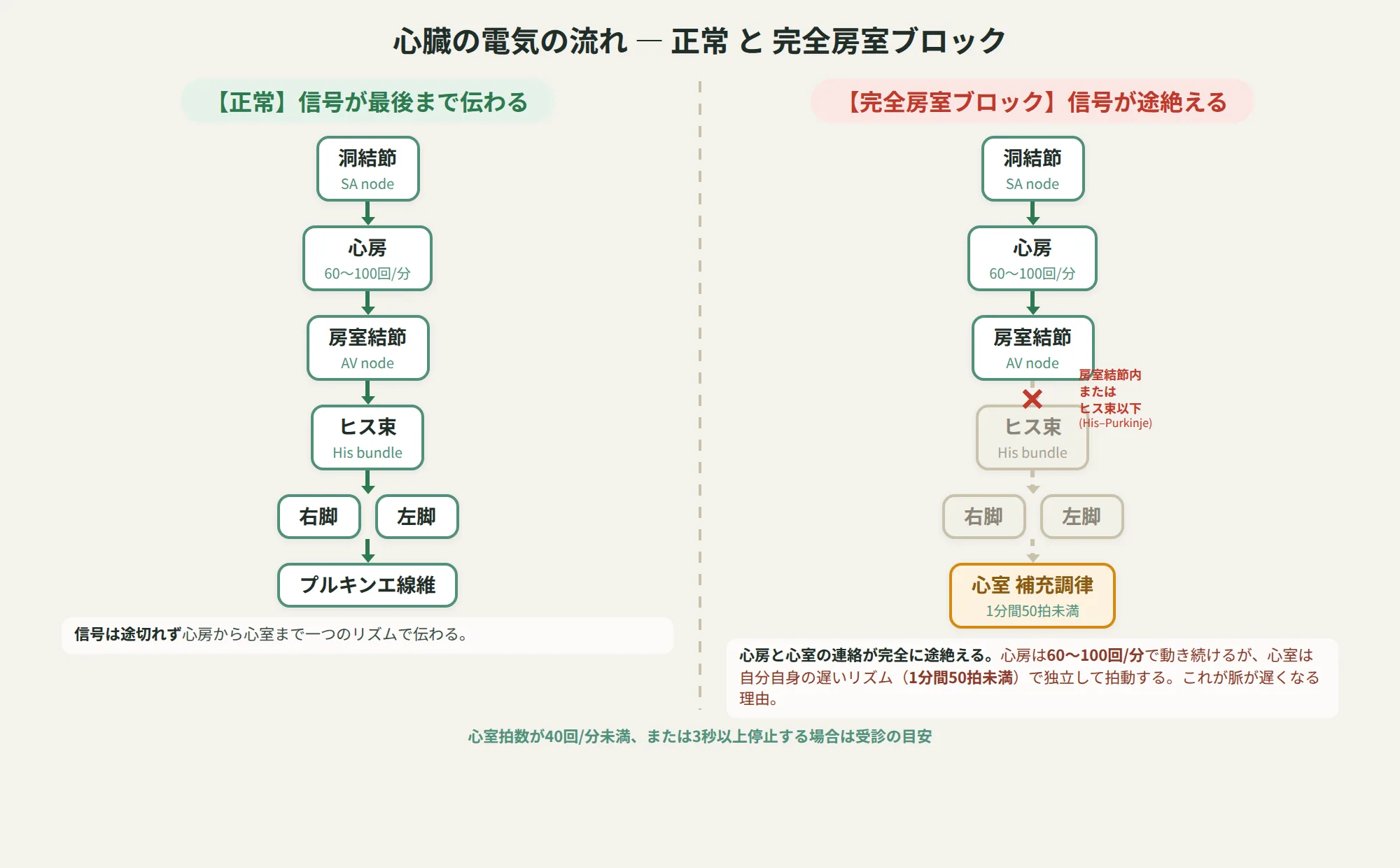 正常時は洞結節から心室まで電気信号が伝わるのに対し、完全房室ブロックでは房室結節内またはヒス束以下で信号が遮断され、心室が補充調律で独立して拍動することを示す図