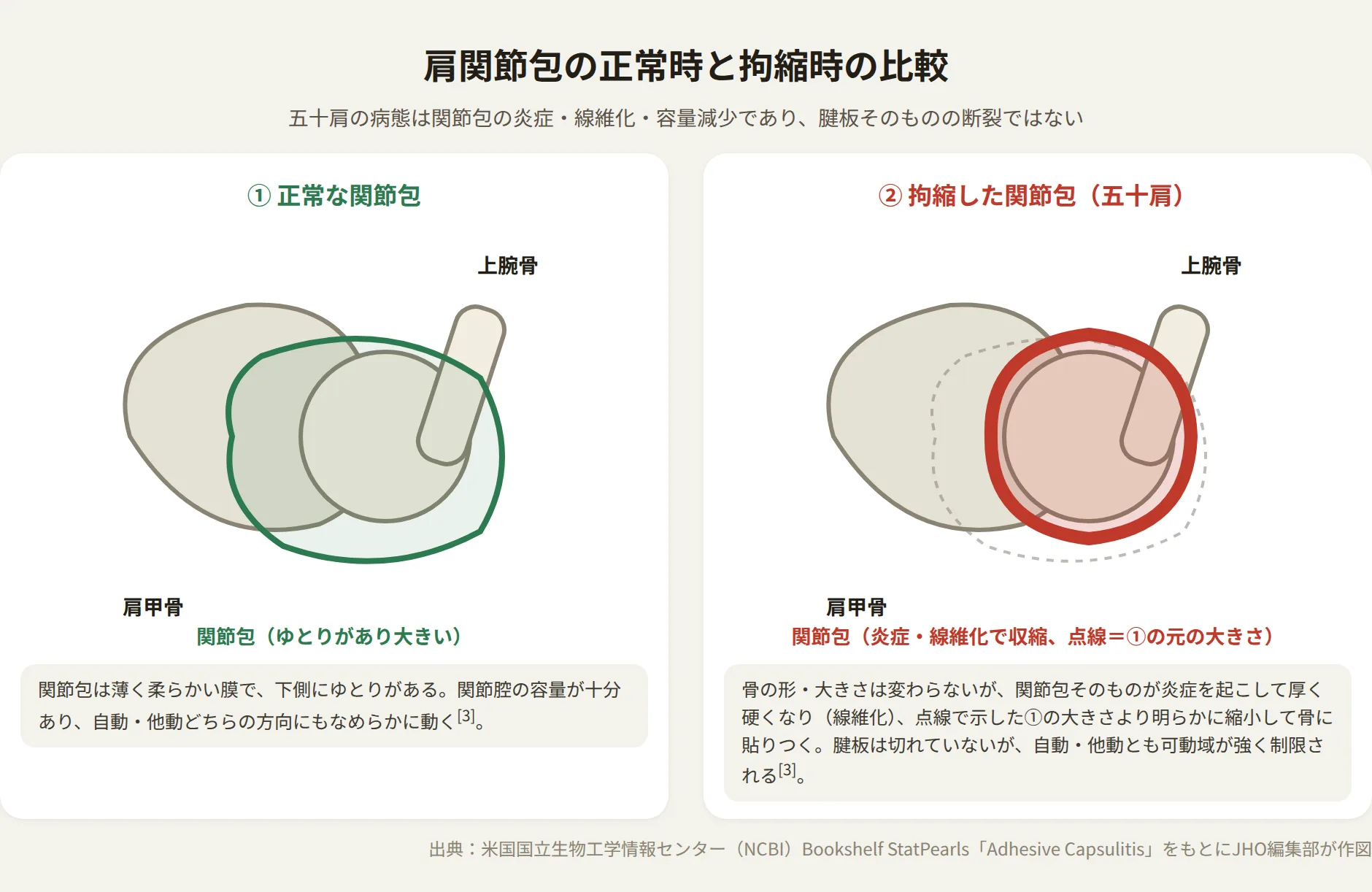 正常な関節包と拘縮した関節包を並べた断面図、炎症・線維化・容量減少を示す
