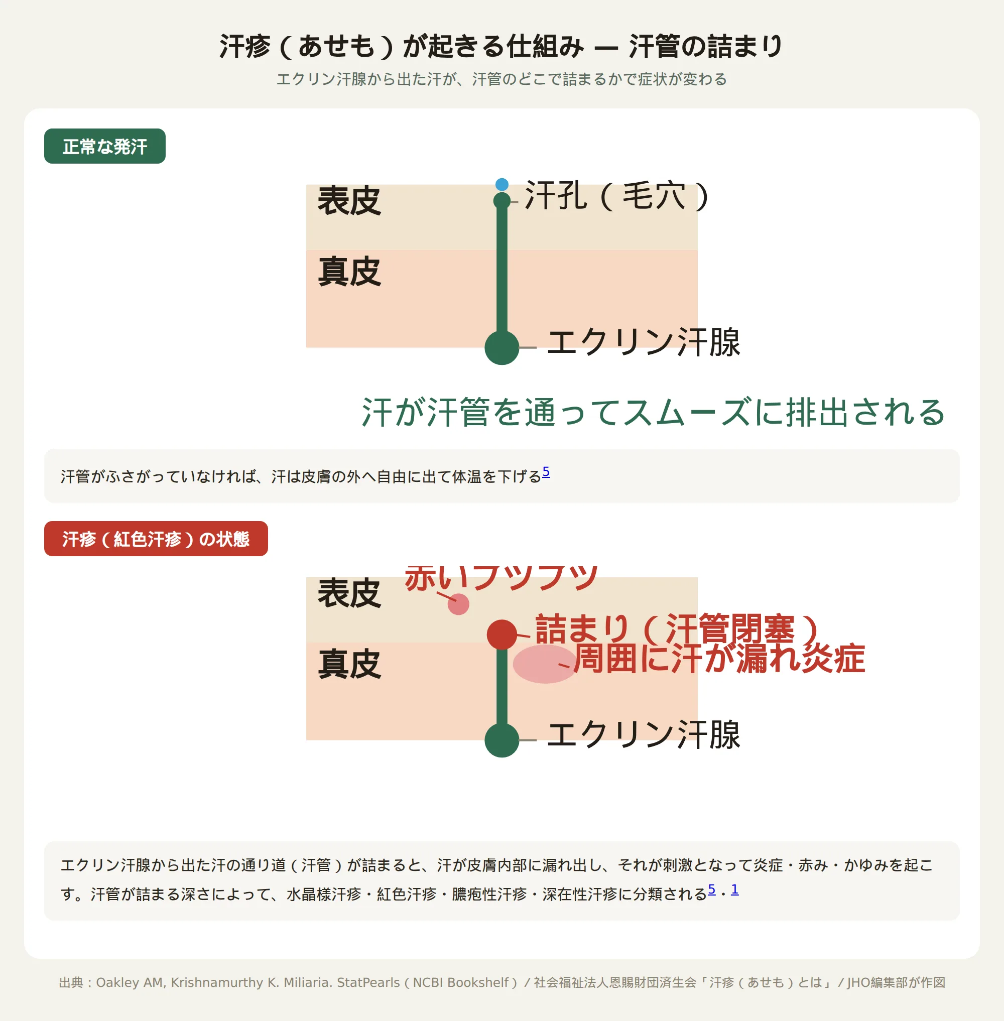 汗疹（あせも）が起きる仕組み。正常な発汗では汗管を通って汗がスムーズに排出されるが、紅色汗疹では汗管が詰まり周囲に汗が漏れて炎症・赤いブツブツが起きる図
