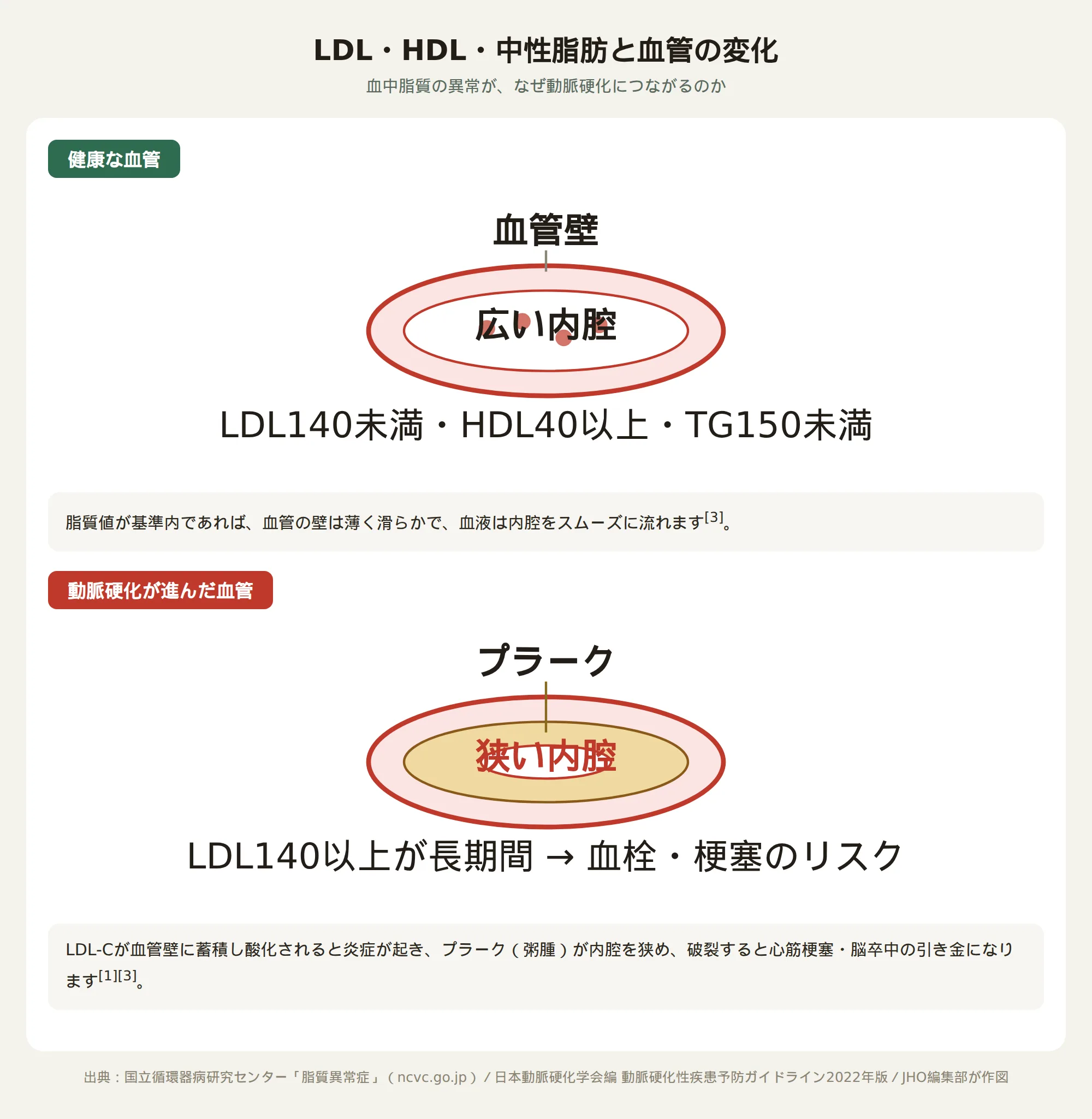 LDLコレステロールが血管壁に蓄積してプラークとなり内腔が狭くなる仕組みの図解