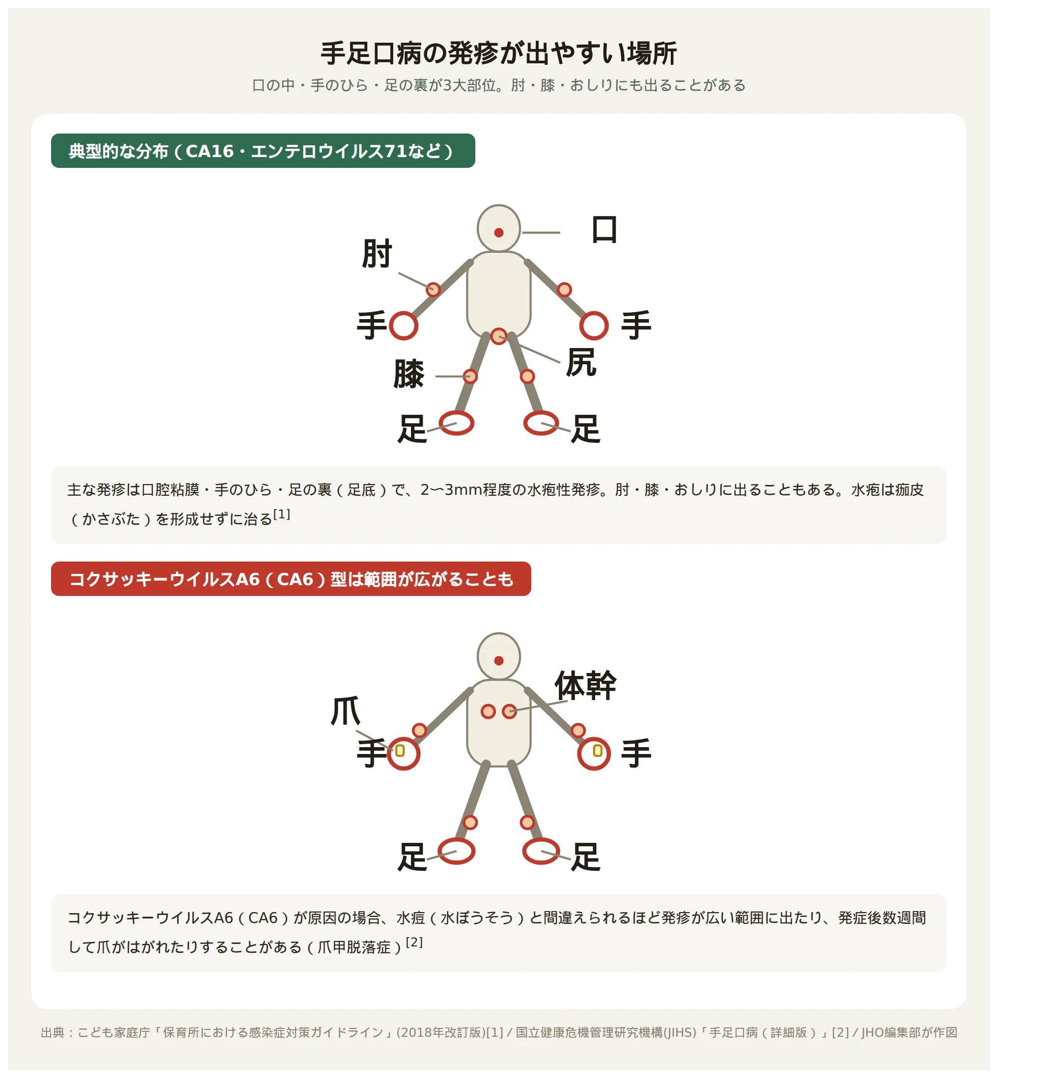 手足口病の発疹が出やすい場所を示す全身図。典型的な分布とコクサッキーA6型の広がりを比較