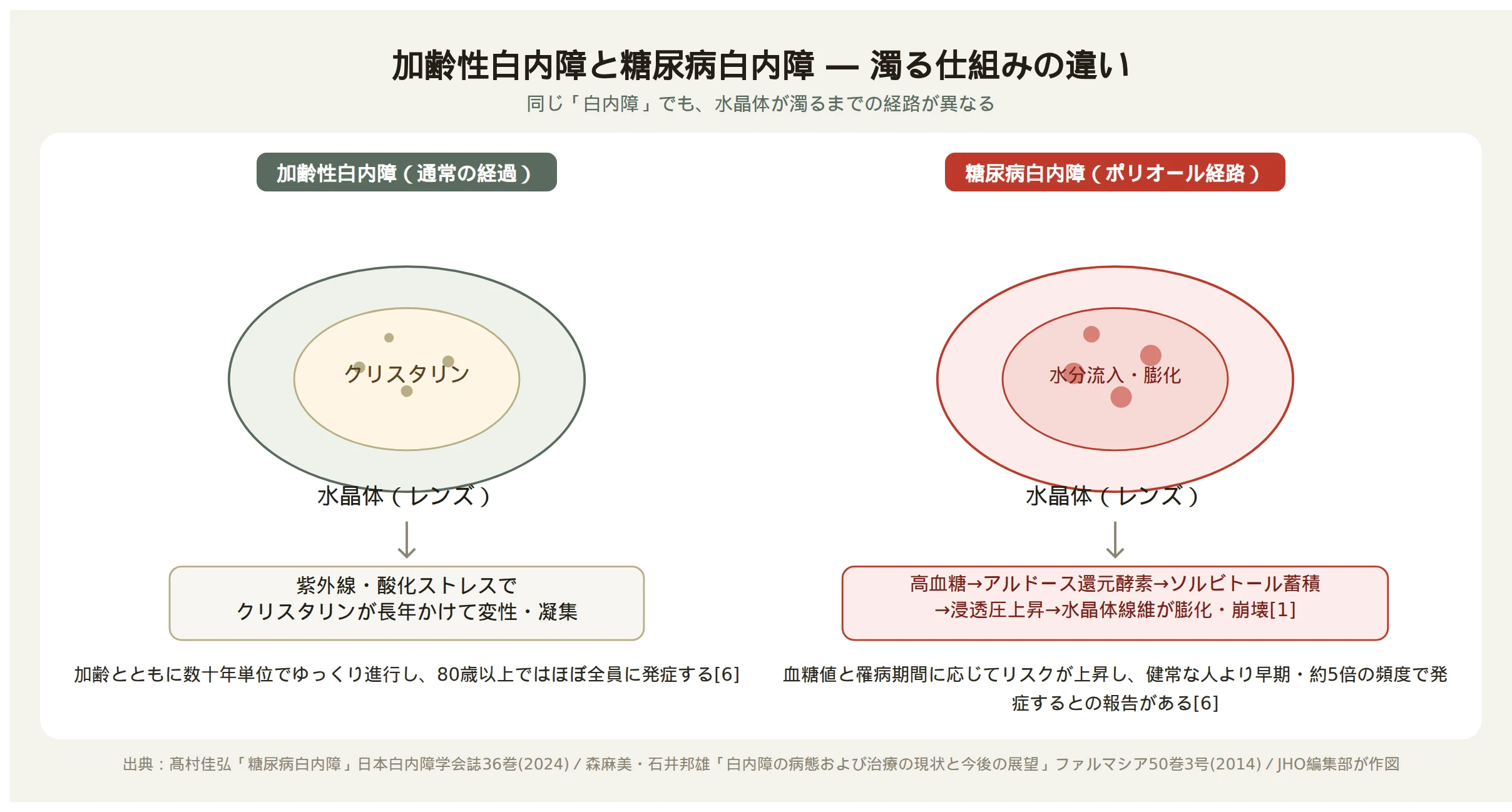 加齢性白内障と糖尿病白内障の濁る仕組みの比較図