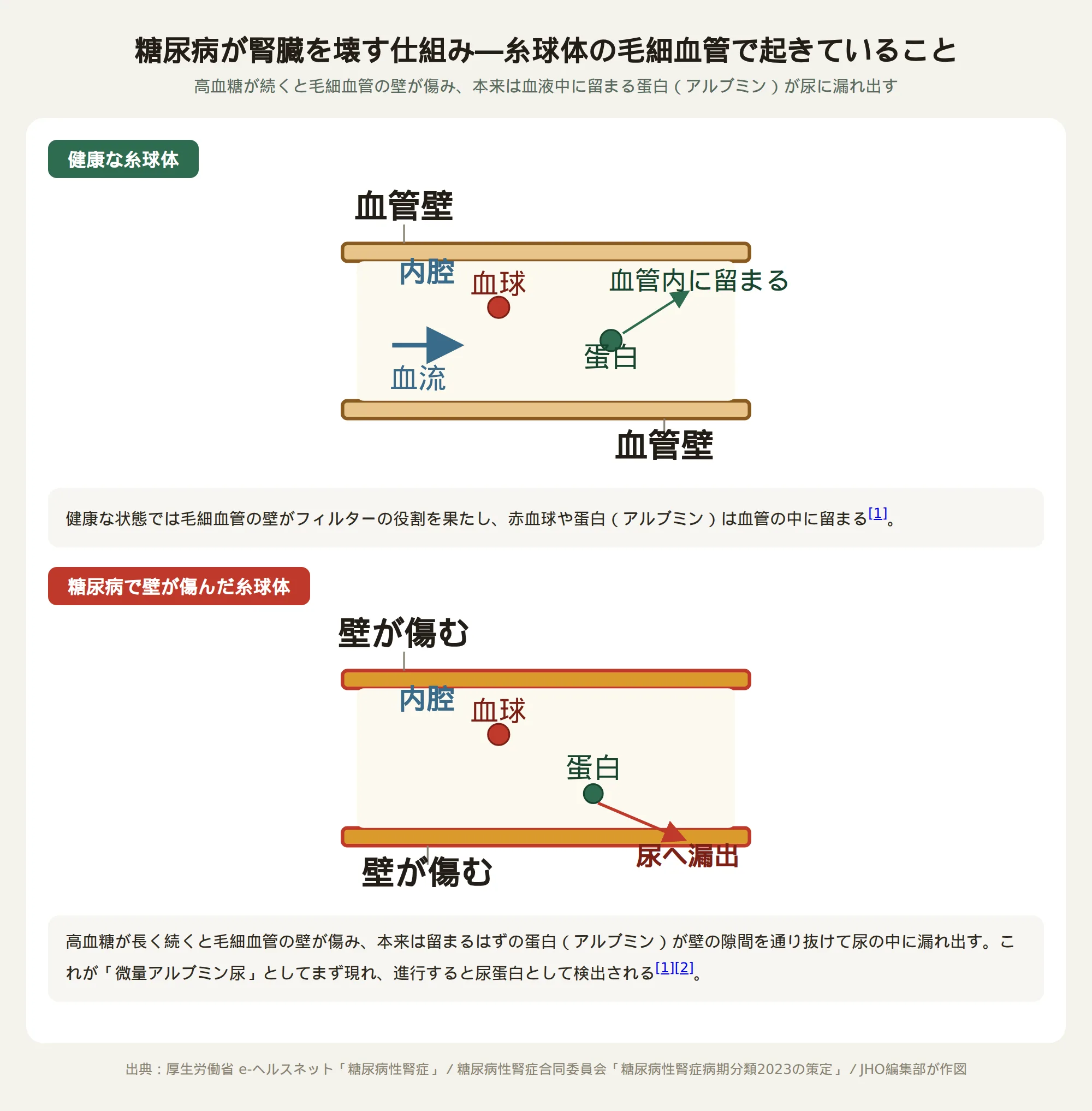糖尿病が腎臓を壊す仕組み。健康な糸球体では蛋白は血管内に留まるが、糖尿病で毛細血管の壁が傷むと蛋白が尿へ漏れ出す