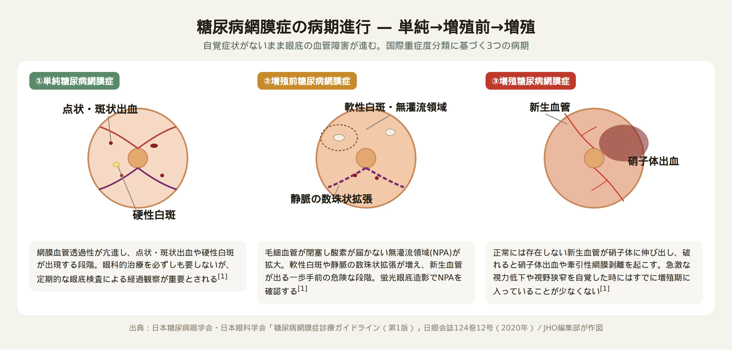 糖尿病網膜症の病期進行を示す図（単純網膜症・増殖前網膜症・増殖網膜症の3段階）
