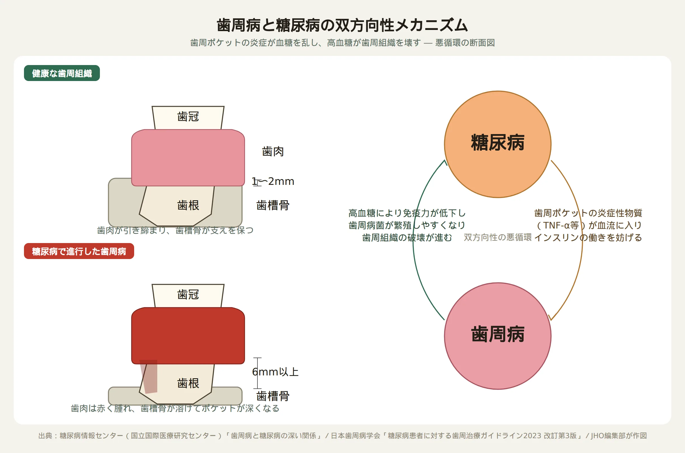 歯周病と糖尿病の双方向性メカニズムを示す断面図とサイクル図。健康な歯周組織では歯肉が引き締まり歯周ポケットは1〜2mmと浅いが、糖尿病で進行した歯周病では歯肉が赤く腫れ歯槽骨が溶けてポケットが6mm以上に深くなる。右側は糖尿病と歯周病が炎症性物質とインスリン抵抗性を介して互いを悪化させる悪循環を表す