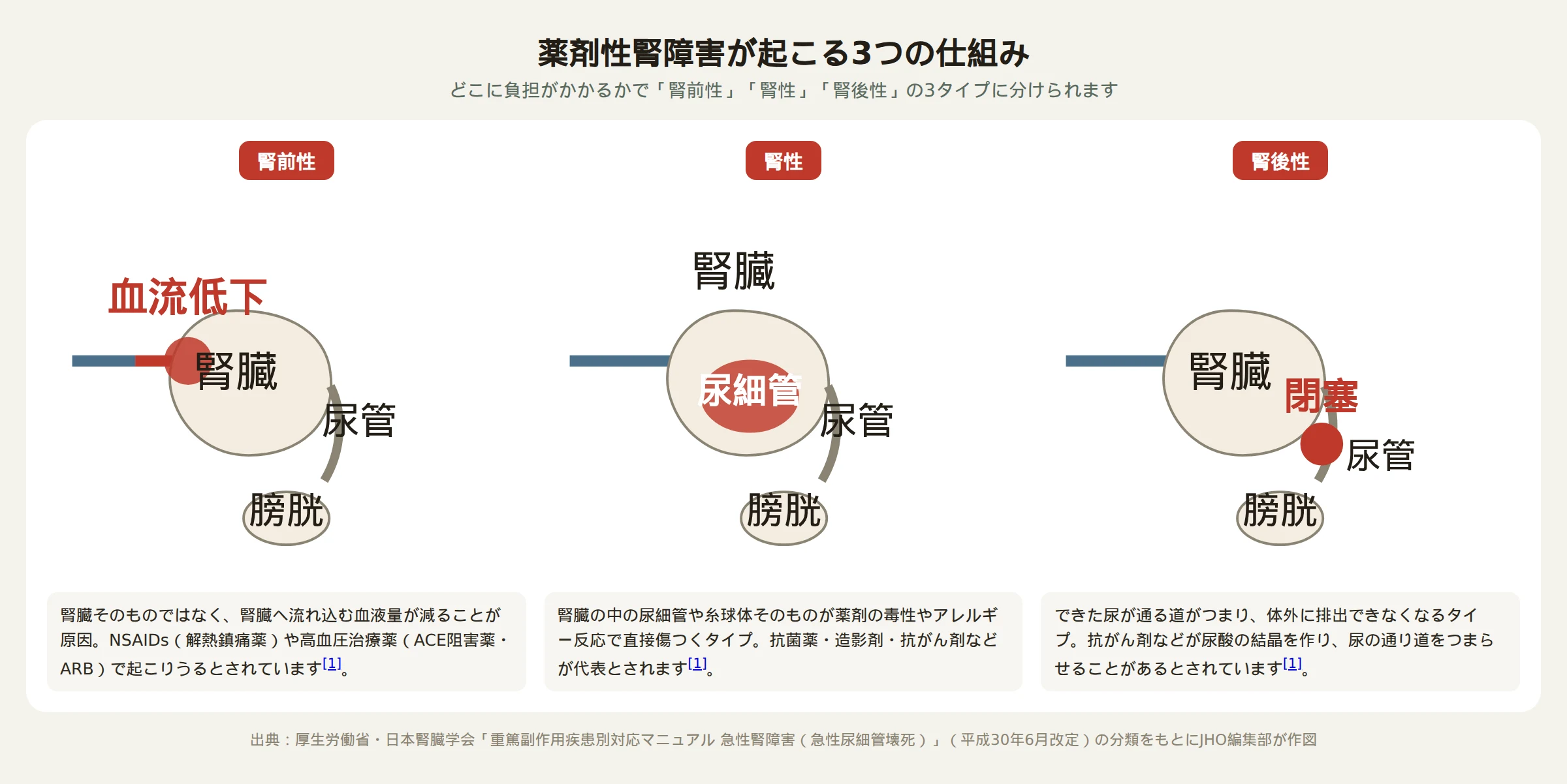薬剤性腎障害が起こる3つの仕組み（腎前性・腎性・腎後性）を示す図