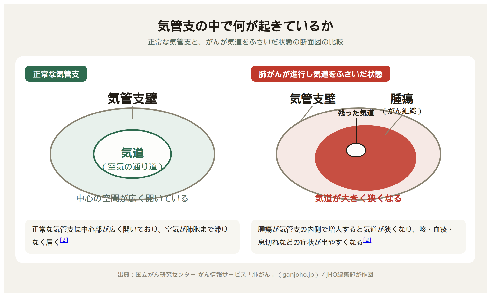 正常な気管支と、肺がんが気道をふさいだ状態の断面図の比較（気管支壁・気道・腫瘍・残った気道をそれぞれ表示）