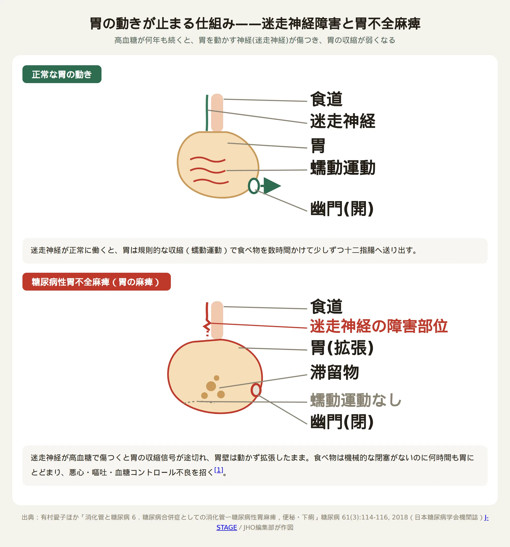 糖尿病性胃不全麻痺で迷走神経が傷つき胃の蠕動運動が止まる仕組みを示す図
