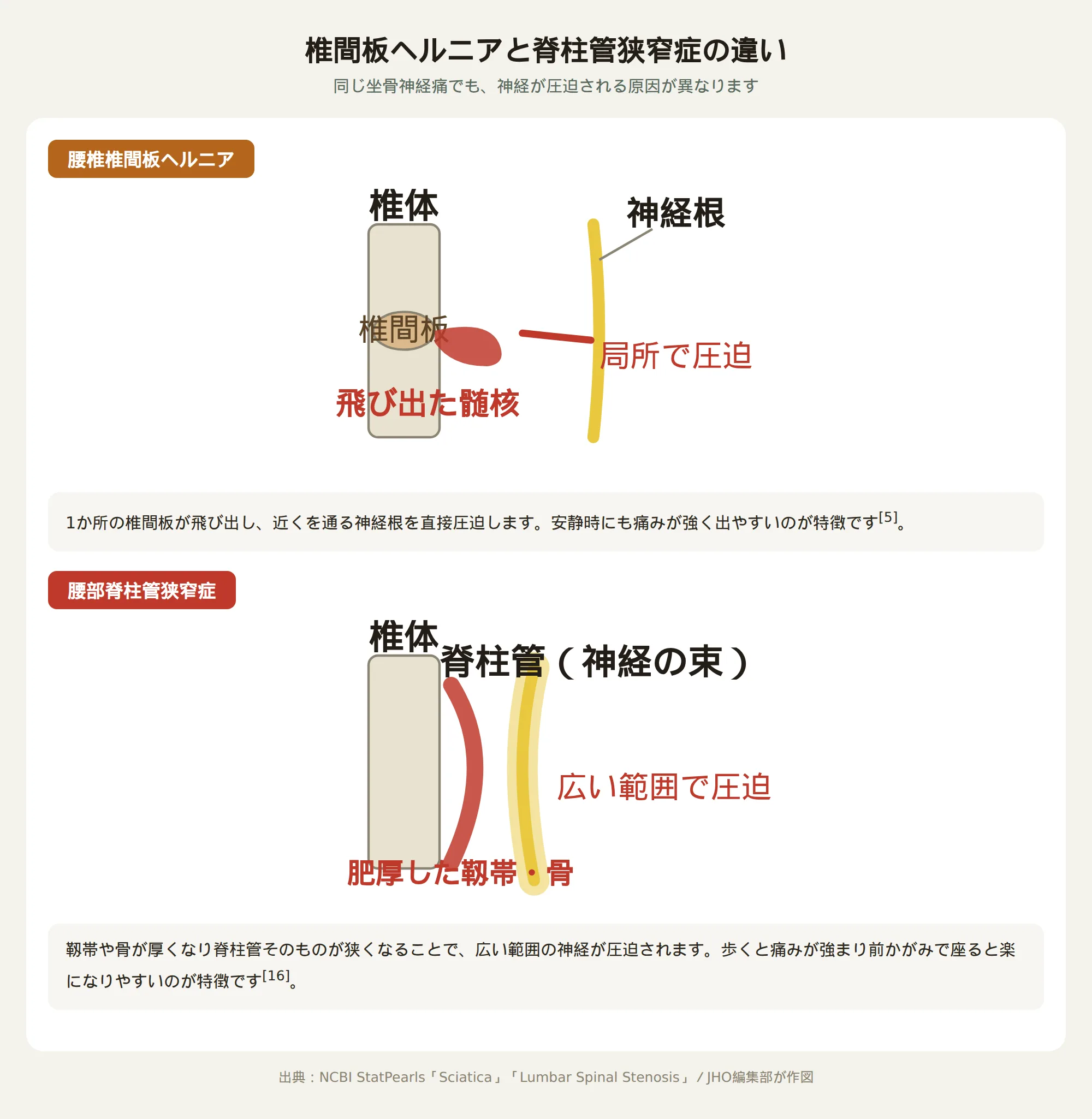 椎間板ヘルニアと脊柱管狭窄症の神経圧迫の違いを示す模式図