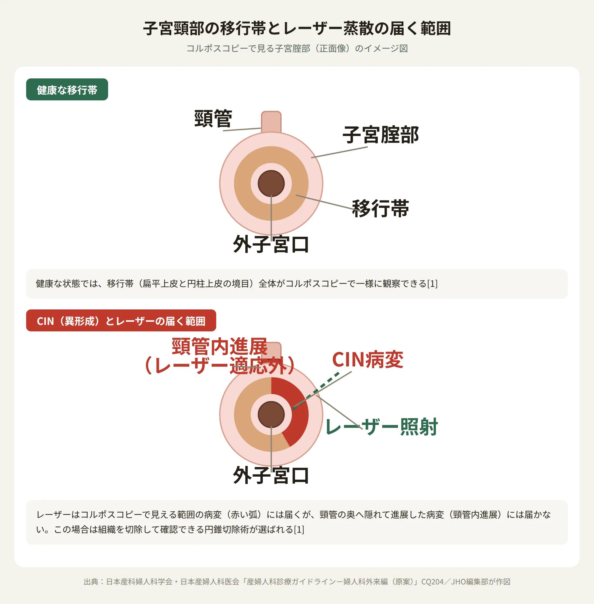 子宮頸部の移行帯とレーザー蒸散が届く範囲・届かない範囲を示す図