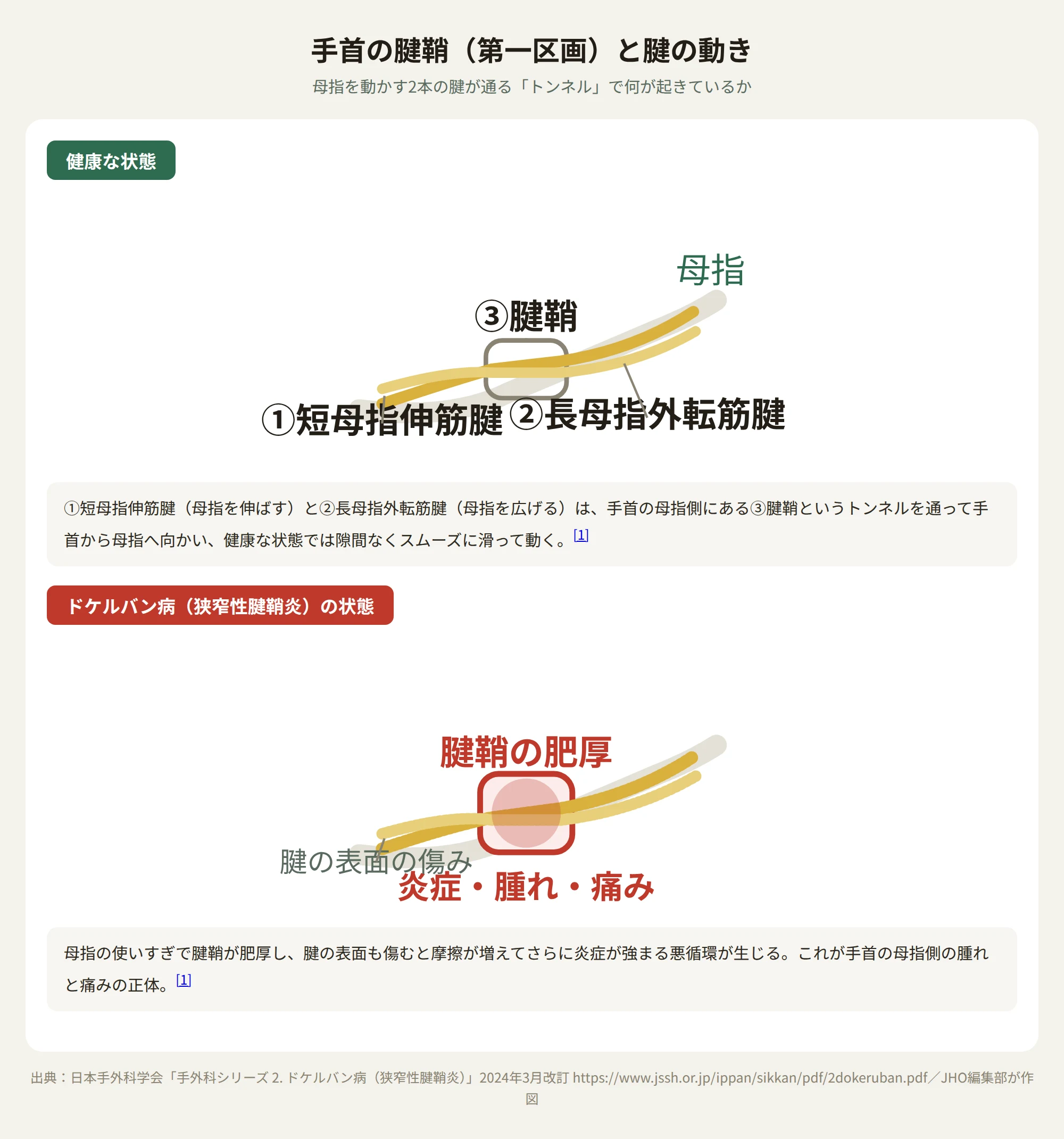 手首の腱鞘（第一区画）の断面図。健康な状態と、腱鞘が肥厚して炎症を起こしたドケルバン病の状態を並べて示す