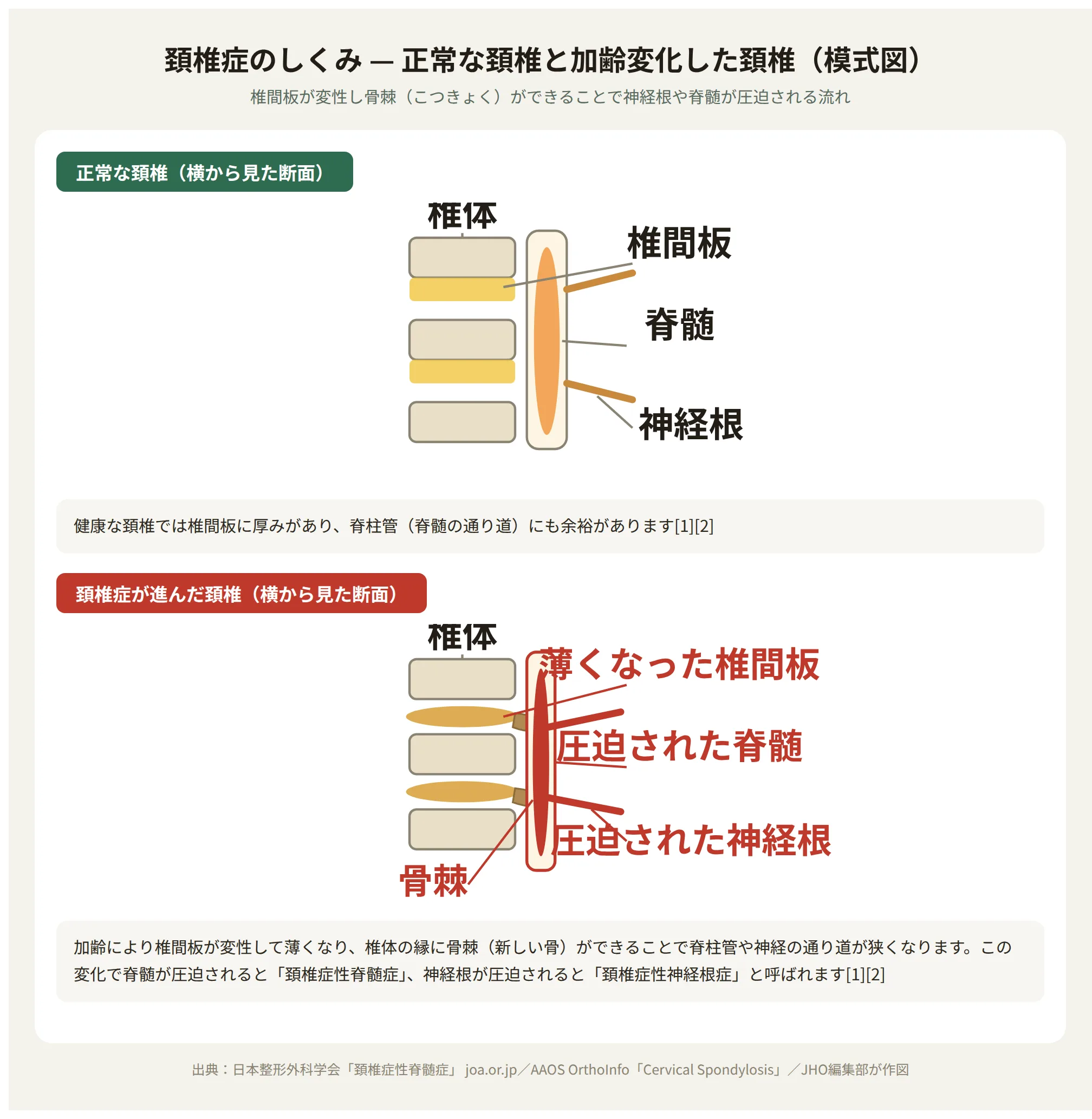 頚椎症のしくみ：正常な頚椎と加齢変化した頚椎の比較模式図