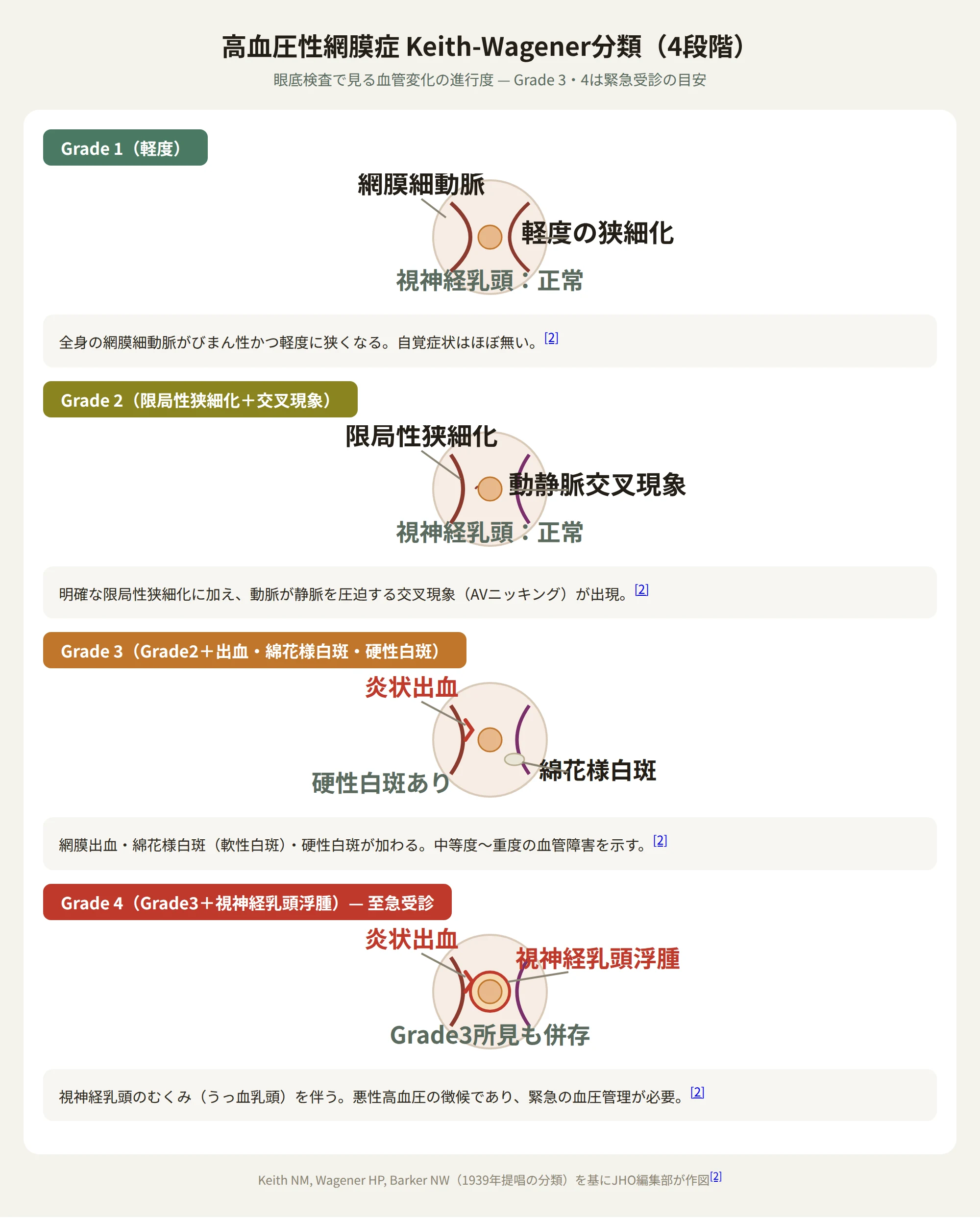 高血圧性網膜症のKeith-Wagener分類、Grade1からGrade4までの眼底血管変化を示す図
