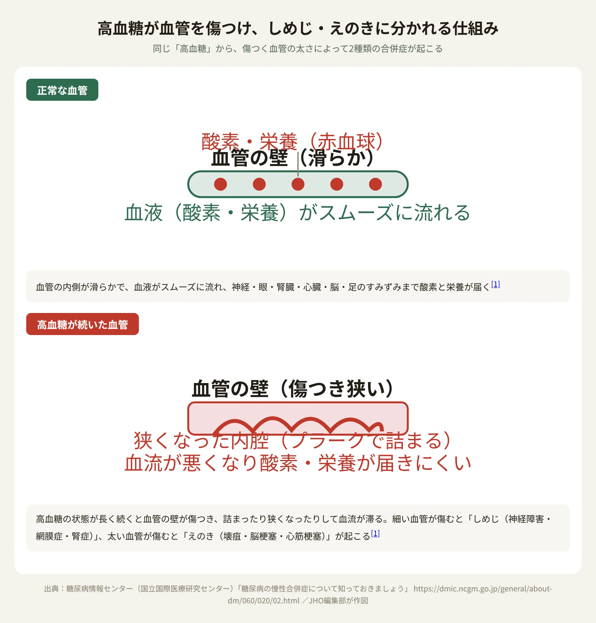 高血糖が血管の壁を傷つけ、しめじ（細小血管症）とえのき（大血管症）に分かれる仕組みを示す図