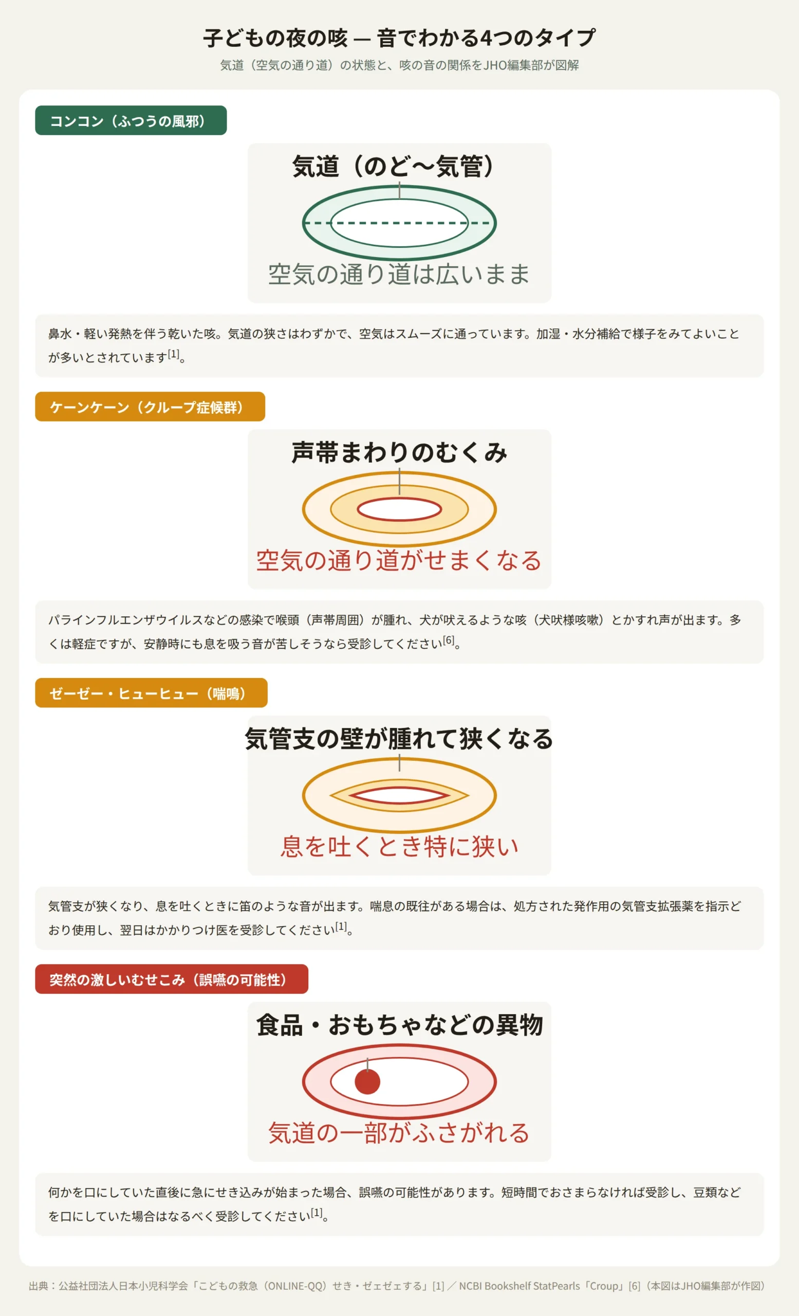 子供の夜の咳を音のタイプ別（コンコン・ケーンケーン・ゼーゼー・むせこみ）に分類した図解