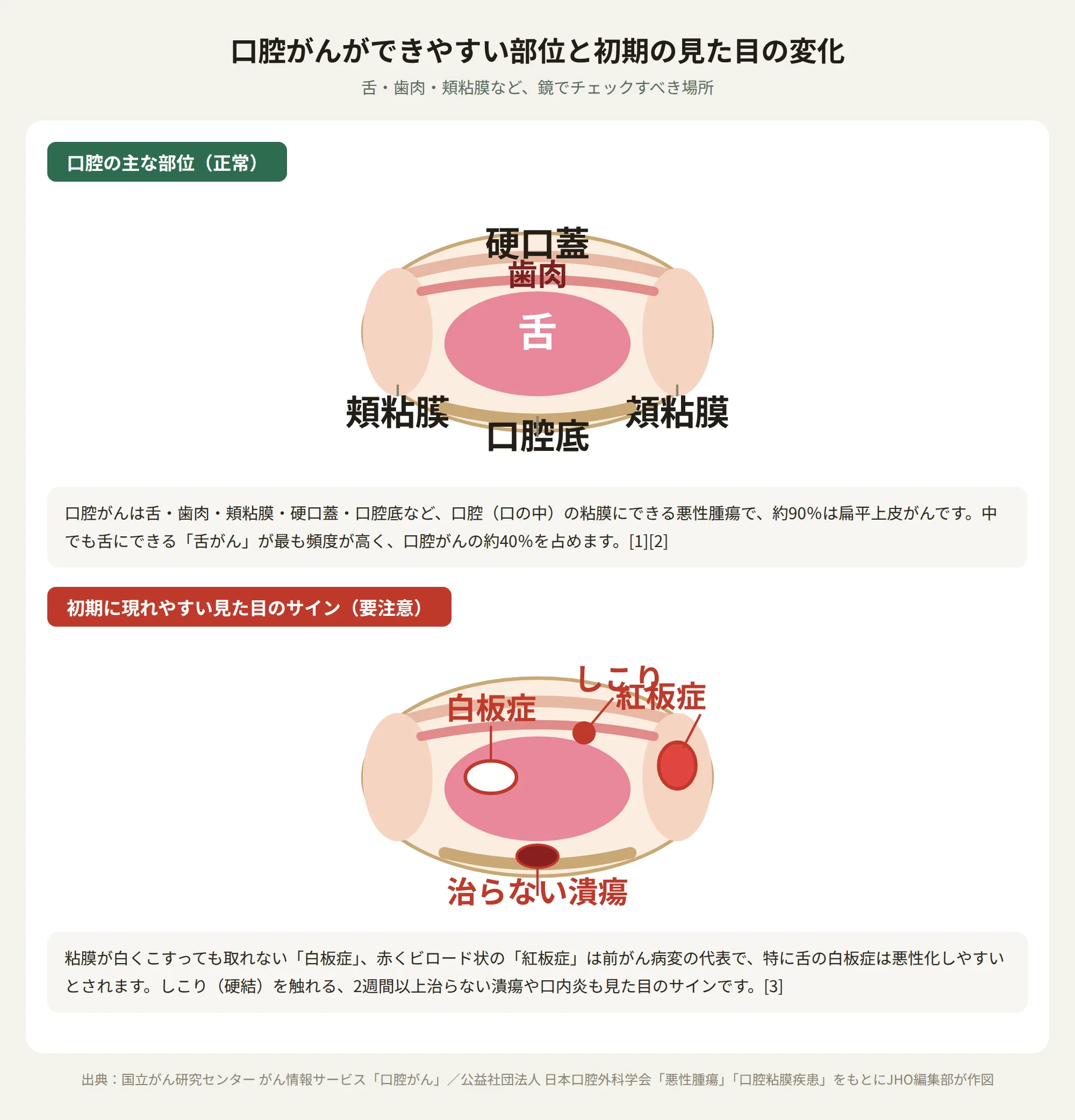 口腔がんができやすい部位（舌・歯肉・頬粘膜・硬口蓋・口腔底）と、白板症・紅板症・しこり・治らない潰瘍など初期に現れやすい見た目のサインを示す図