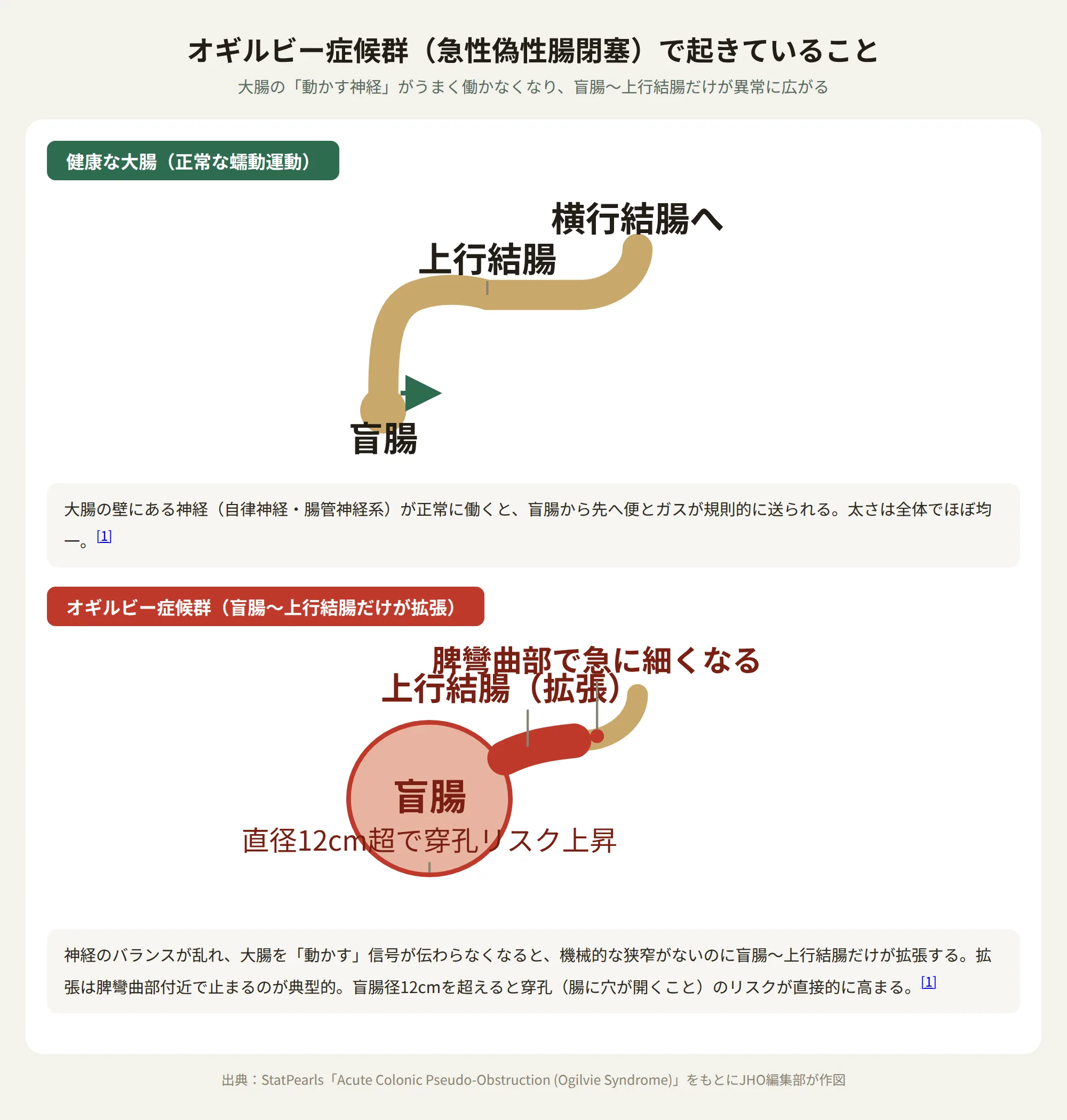 健康な大腸とオギルビー症候群（急性偽性腸閉塞）で盲腸〜上行結腸が拡張する様子の比較図