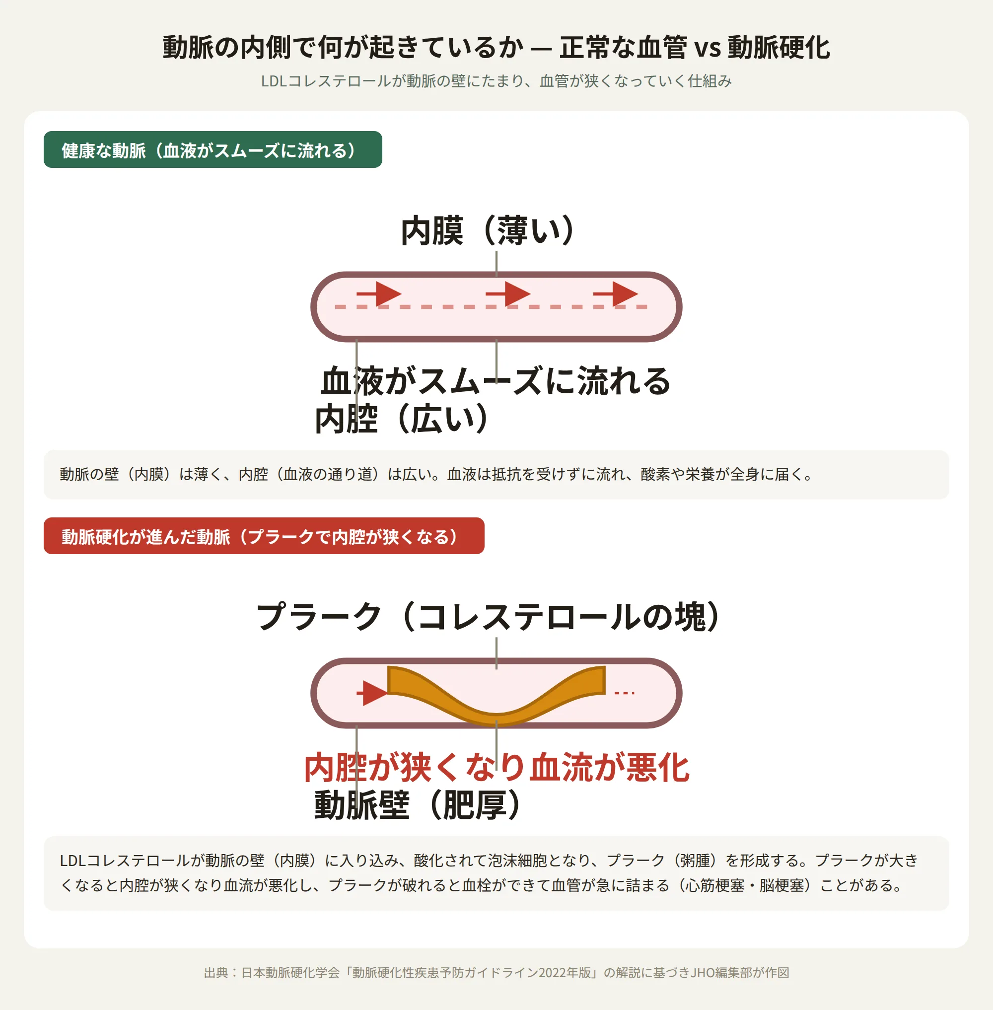 動脈の内側で何が起きているかを示す図。健康な動脈は内膜が薄く内腔が広いが、動脈硬化が進んだ動脈はプラーク（コレステロールの塊）が蓄積して内腔が狭くなり血流が悪化する。