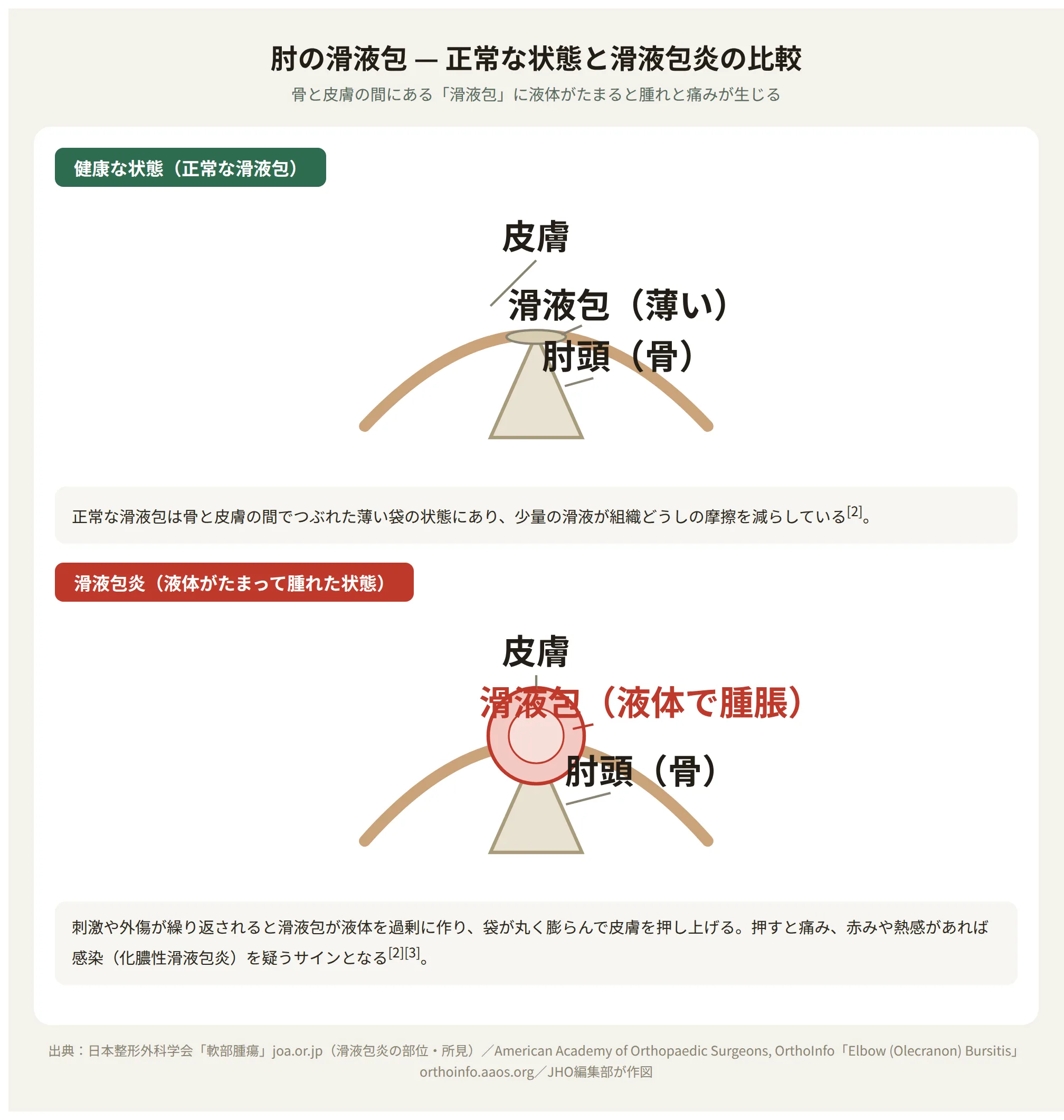 肘の滑液包 正常な状態と滑液包炎（液体で腫脹した状態）の比較図