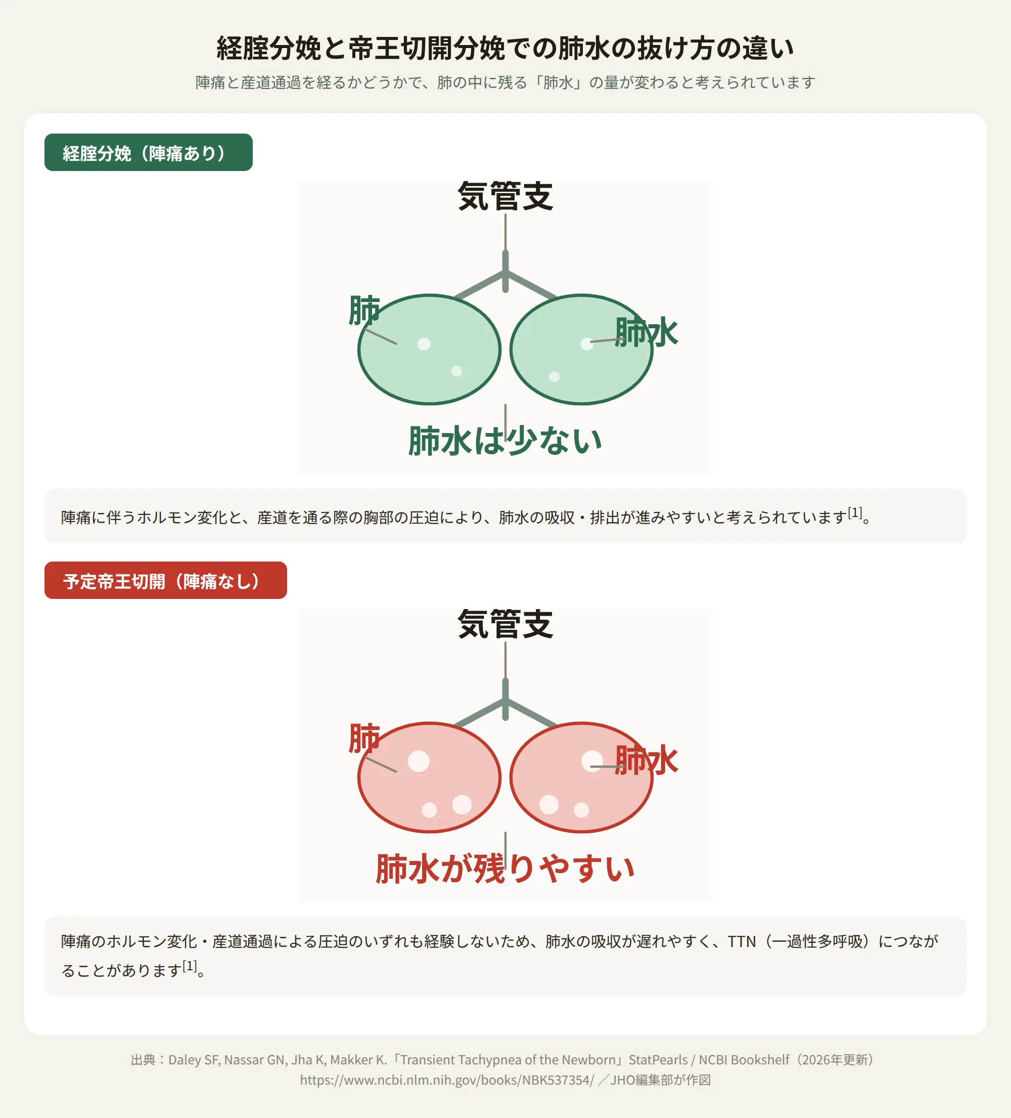 経腟分娩と帝王切開分娩における肺水の抜け方の違いを示す図。帝王切開児は肺水が残りやすい