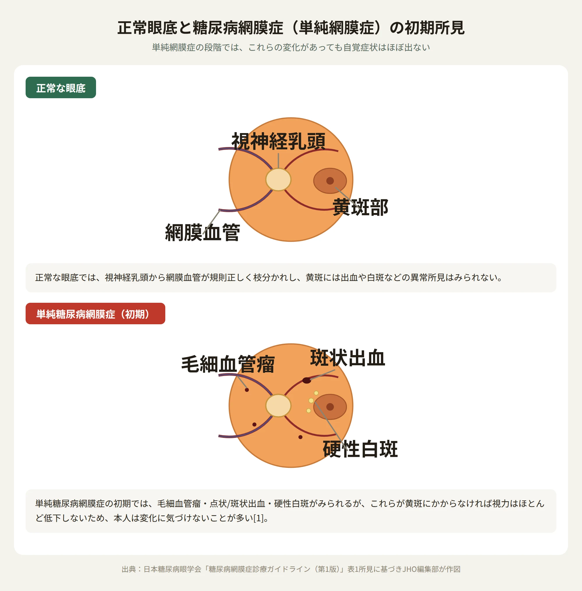 正常眼底と糖尿病網膜症(単純網膜症)の初期所見。毛細血管瘤・斑状出血・硬性白斑があっても黄斑にかからなければ自覚症状はほぼ出ない